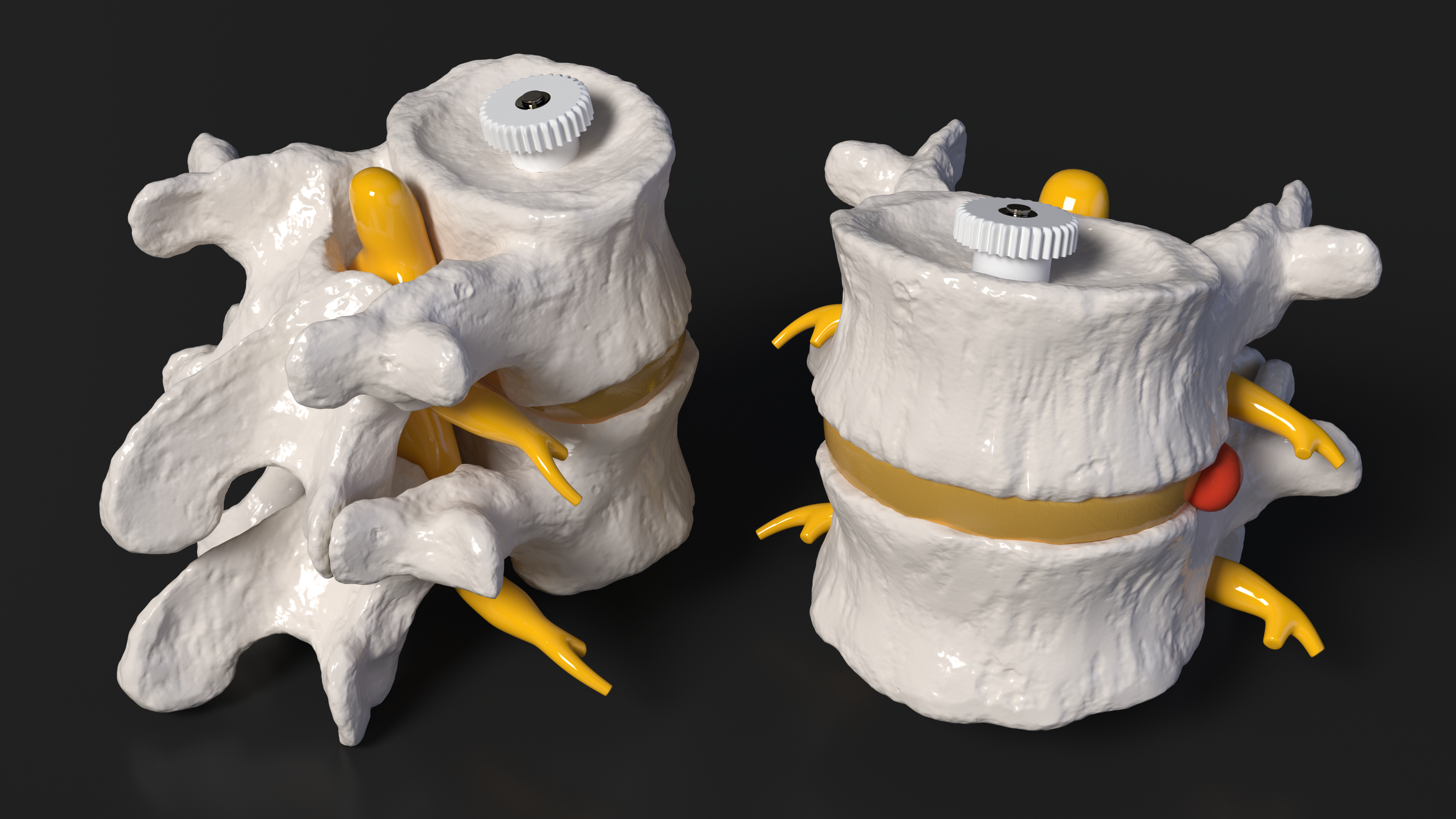 Part of Spinal Column with Hernia, view 6