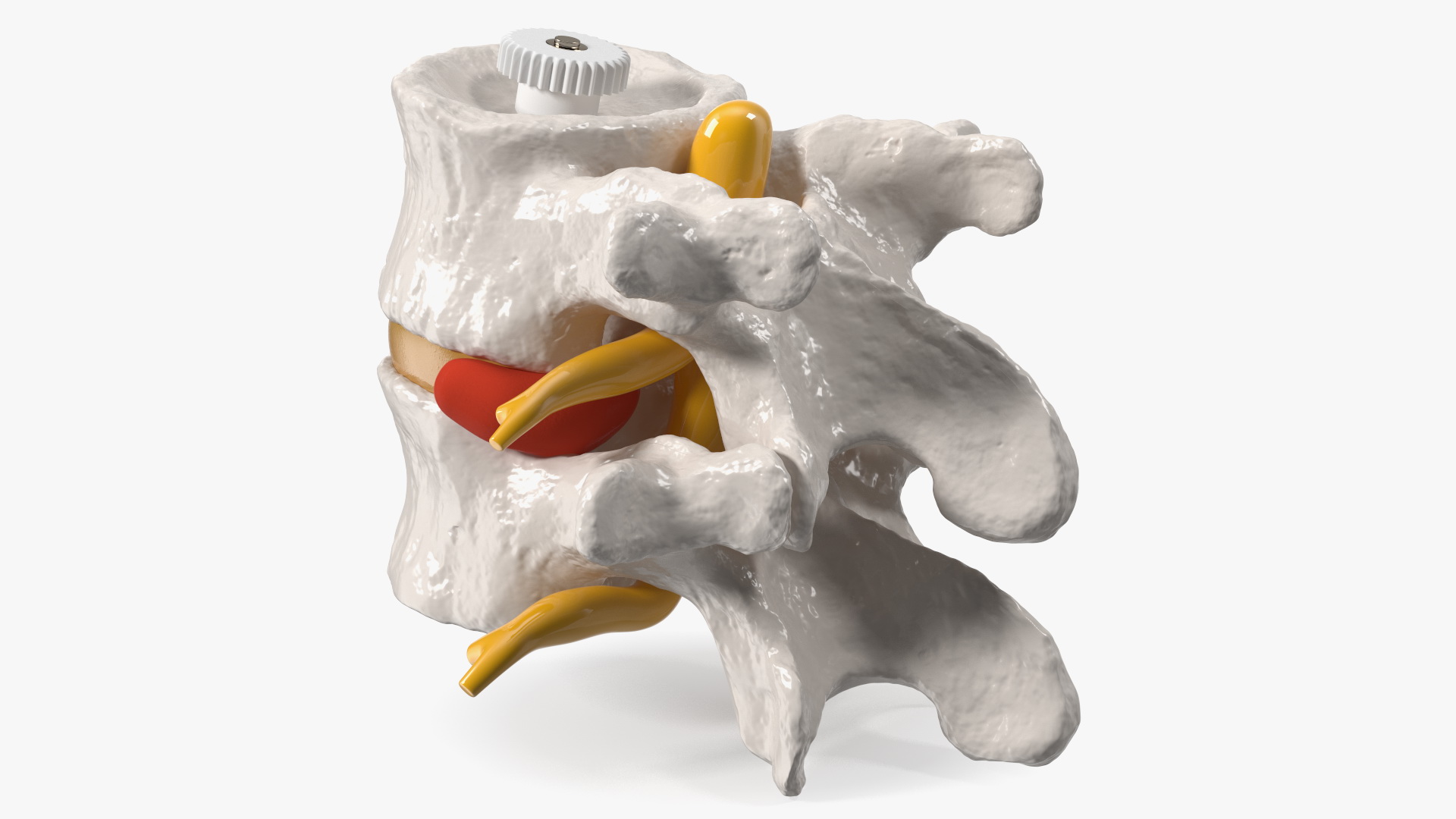 3D Part of Spinal Column with Hernia model