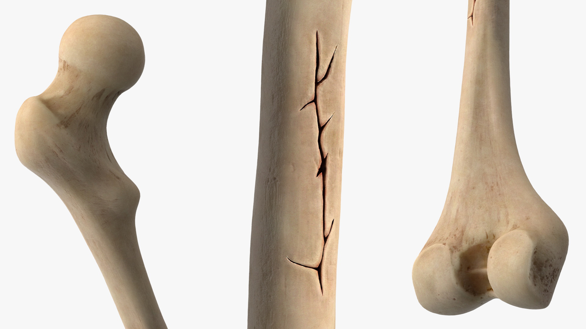 Human Femur Bone Anatomy - view 5
