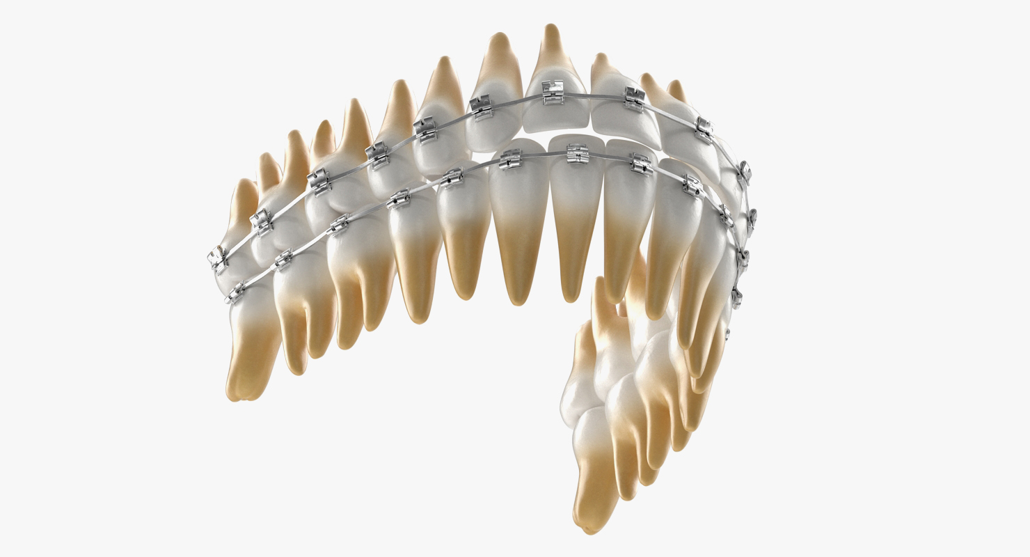 3D Teeth with Braces Model model