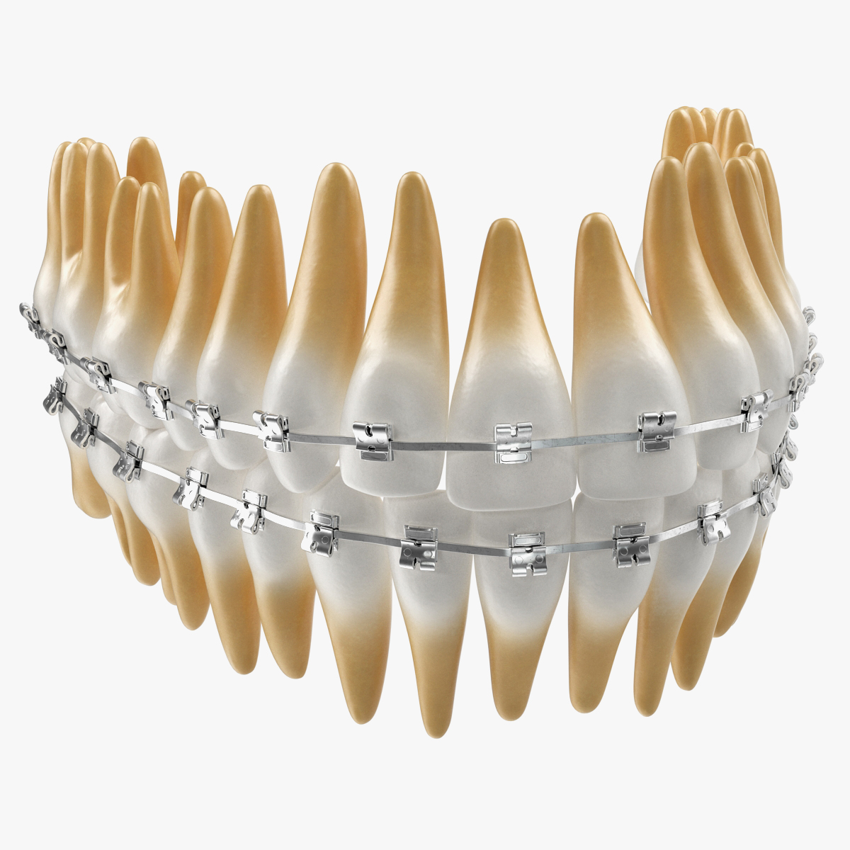 Teeth with Braces Model 3D