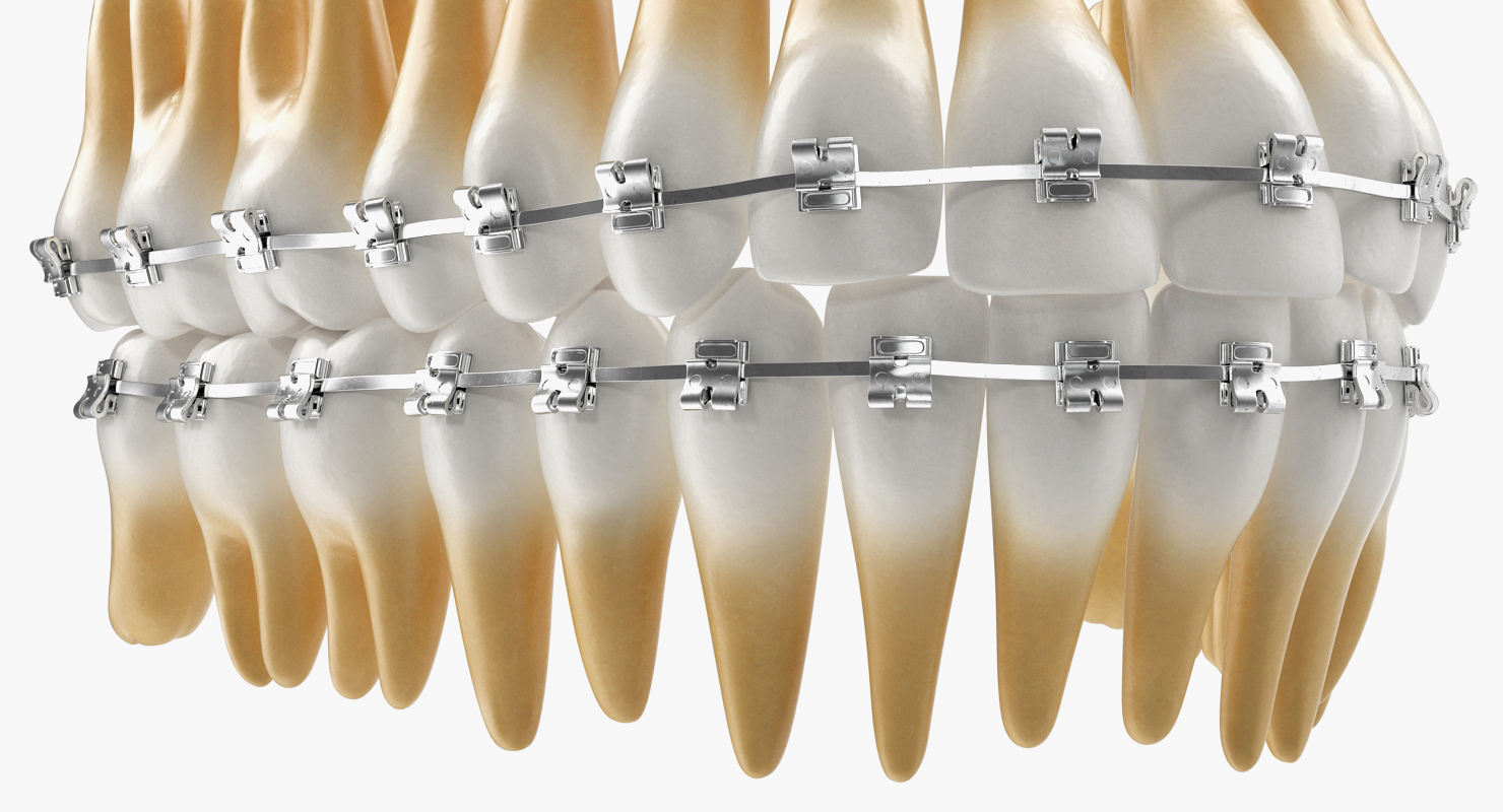 3D Teeth with Braces Model model