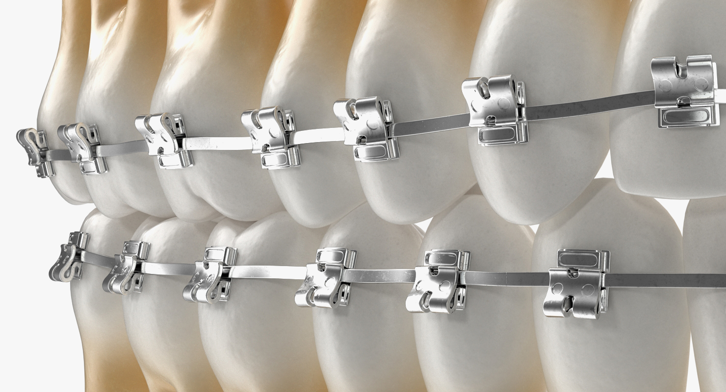 3D Teeth with Braces Model model