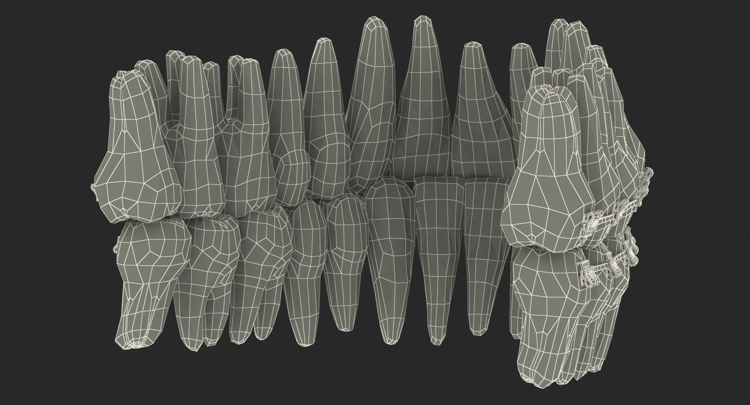 3D Teeth with Braces Model model