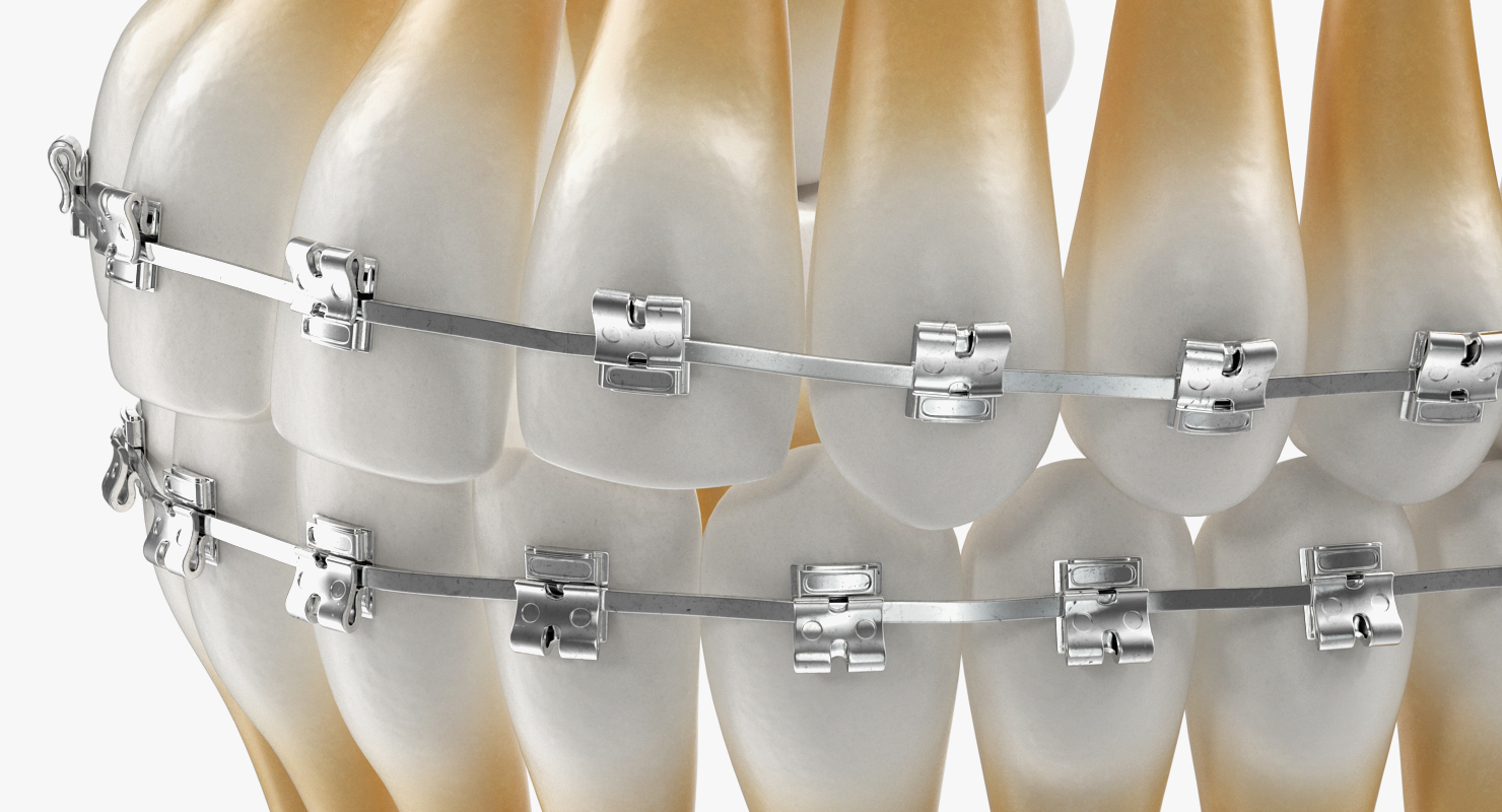 3D Teeth with Braces Model model