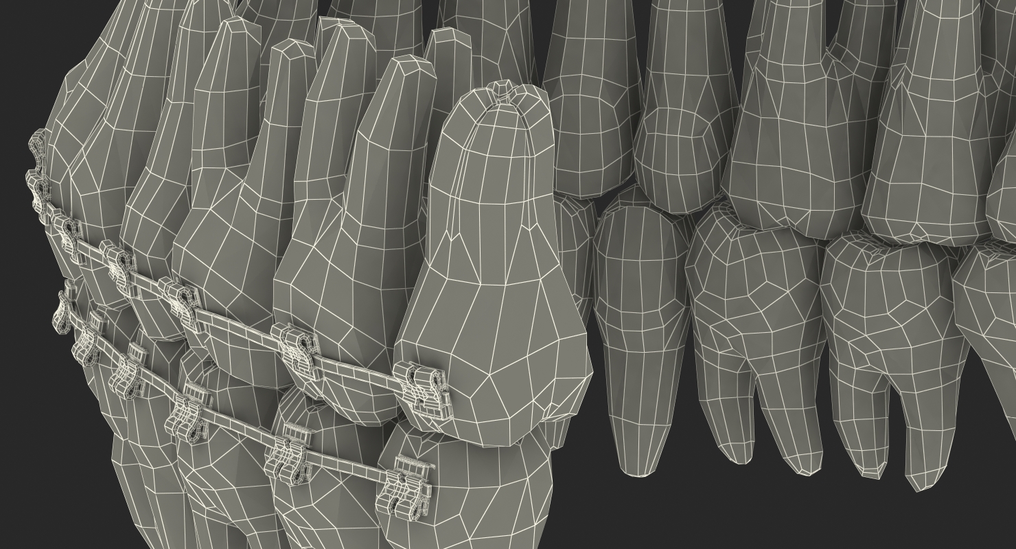 3D Teeth with Braces Model model