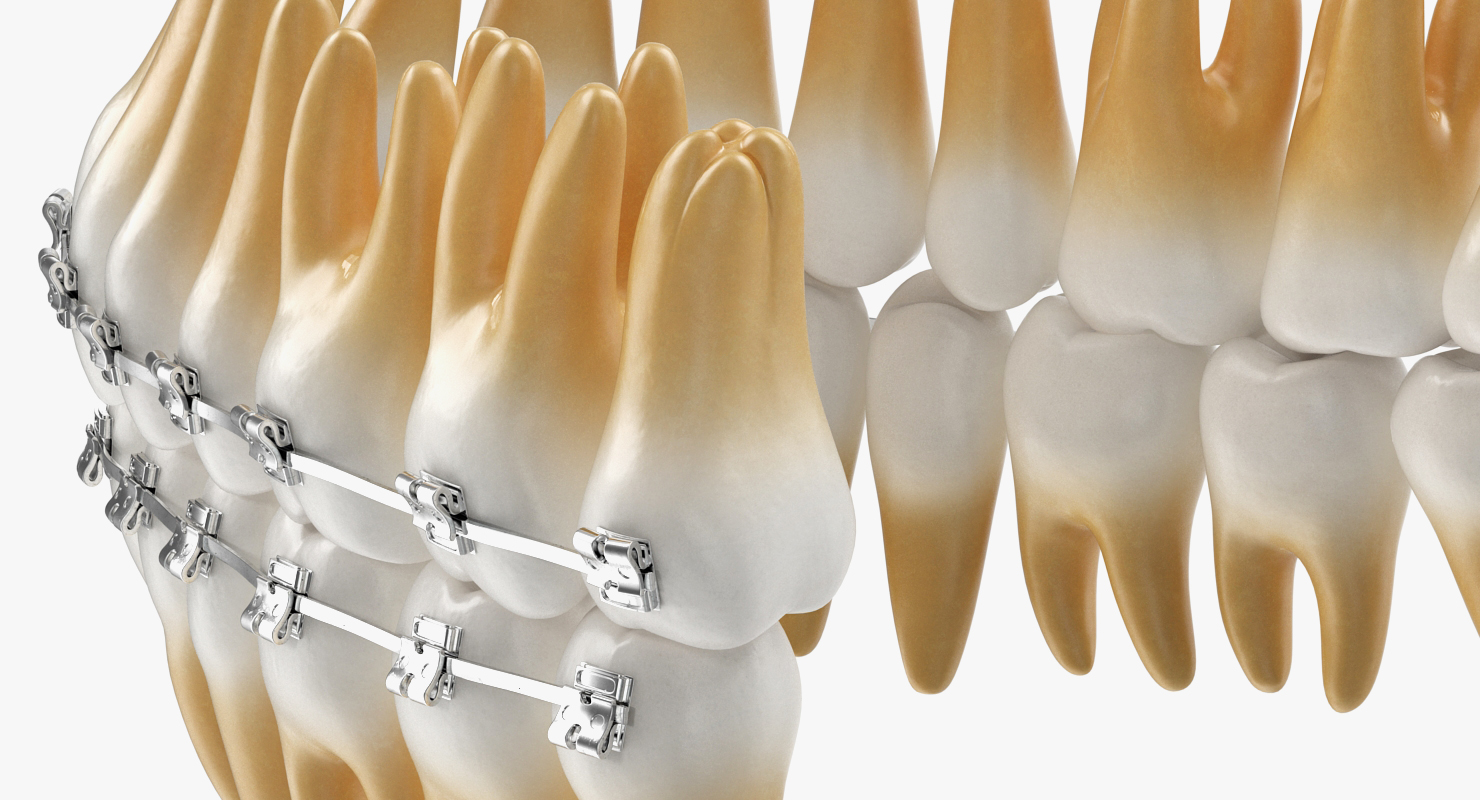 3D Teeth with Braces Model model