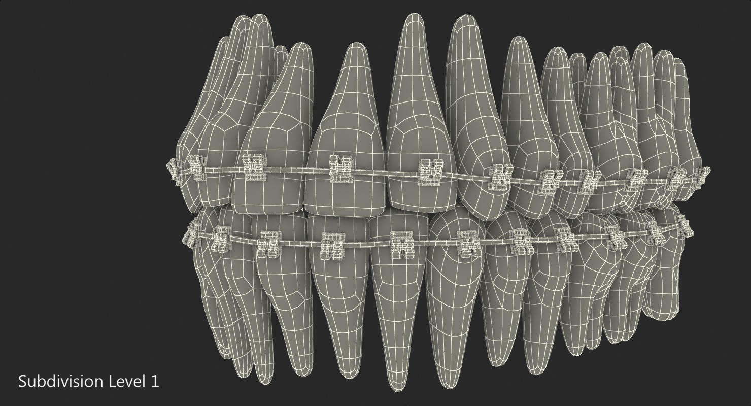 3D Teeth with Braces Model model