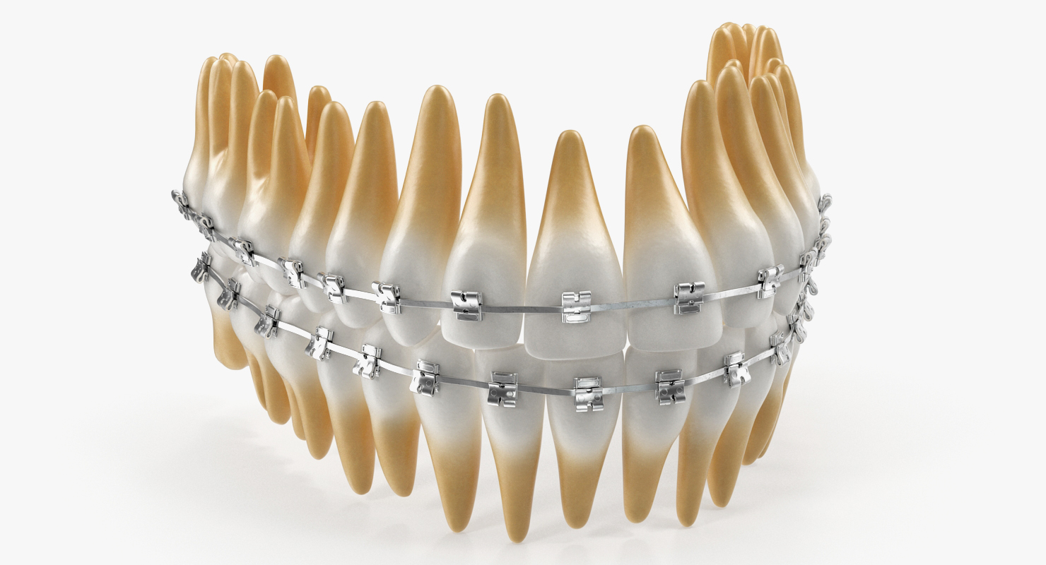 3D Teeth with Braces Model model