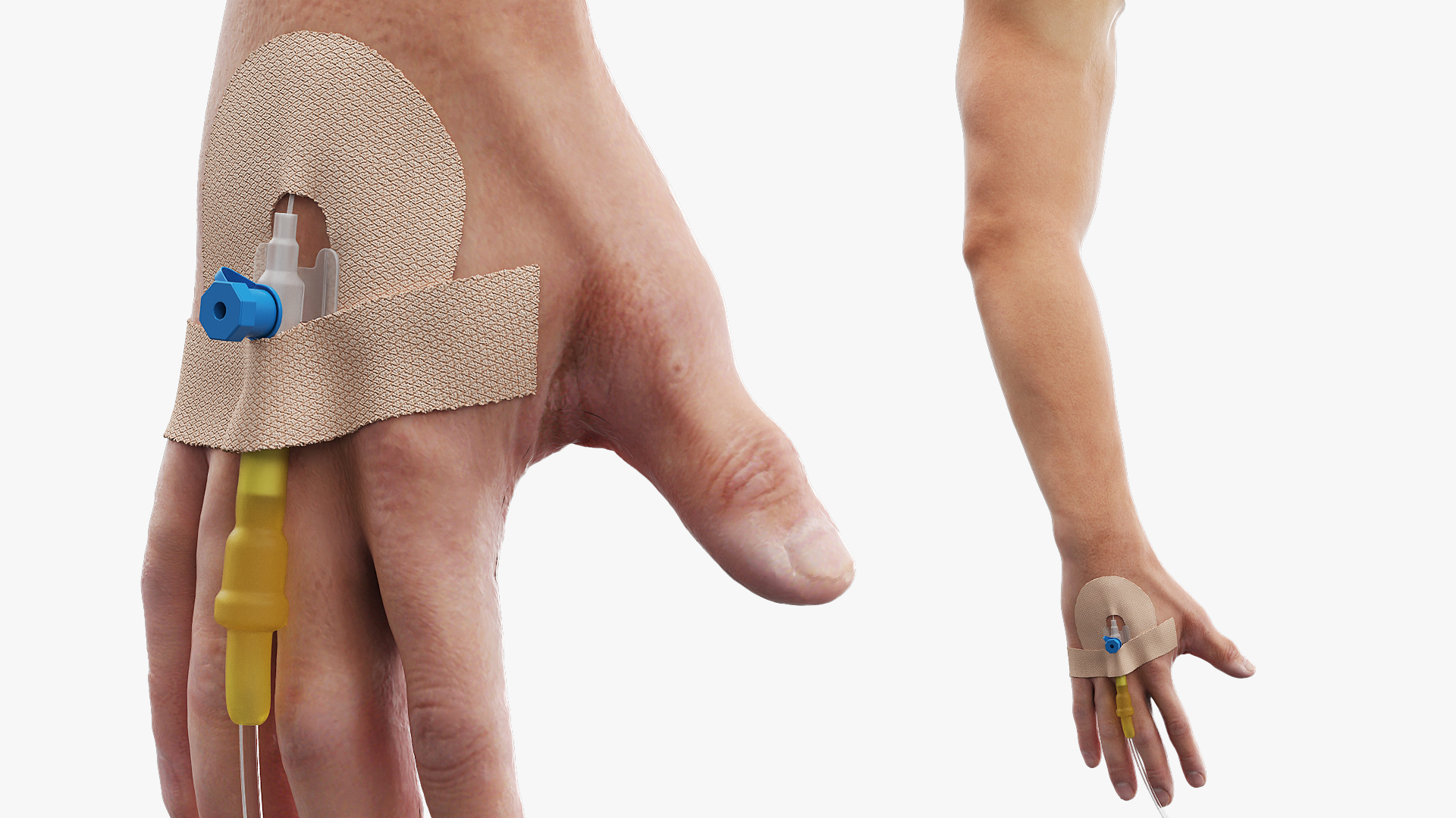 Peripheral IV Cannula with Hand Fixation - view 2