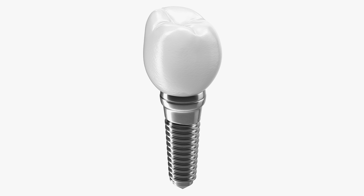 3D model Tooth Dental Implant