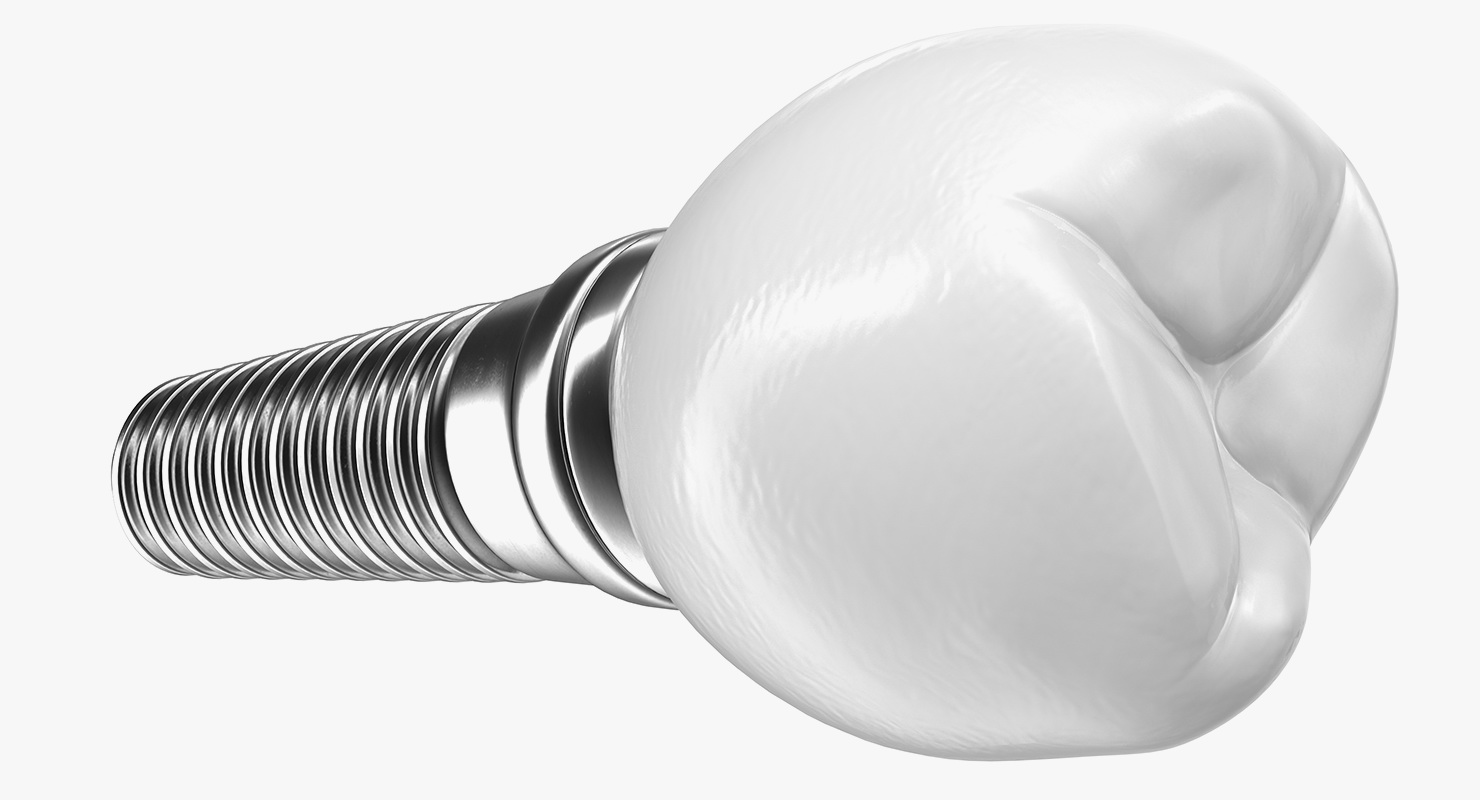 3D model Tooth Dental Implant