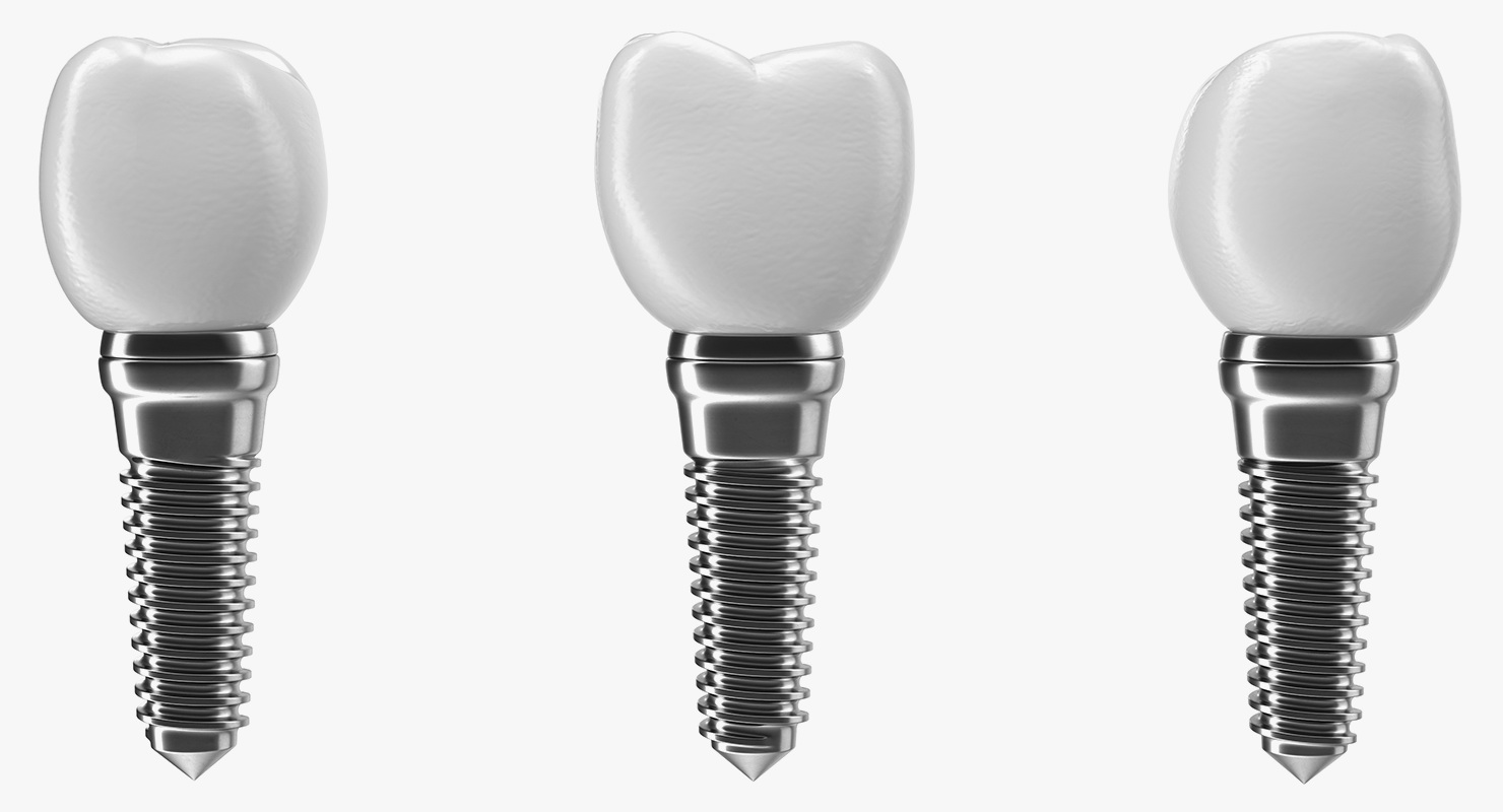 3D model Tooth Dental Implant