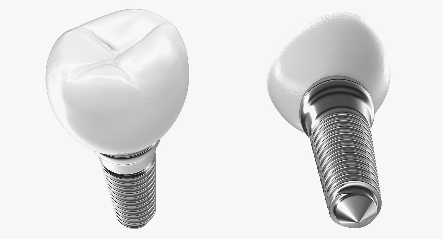 3D model Tooth Dental Implant