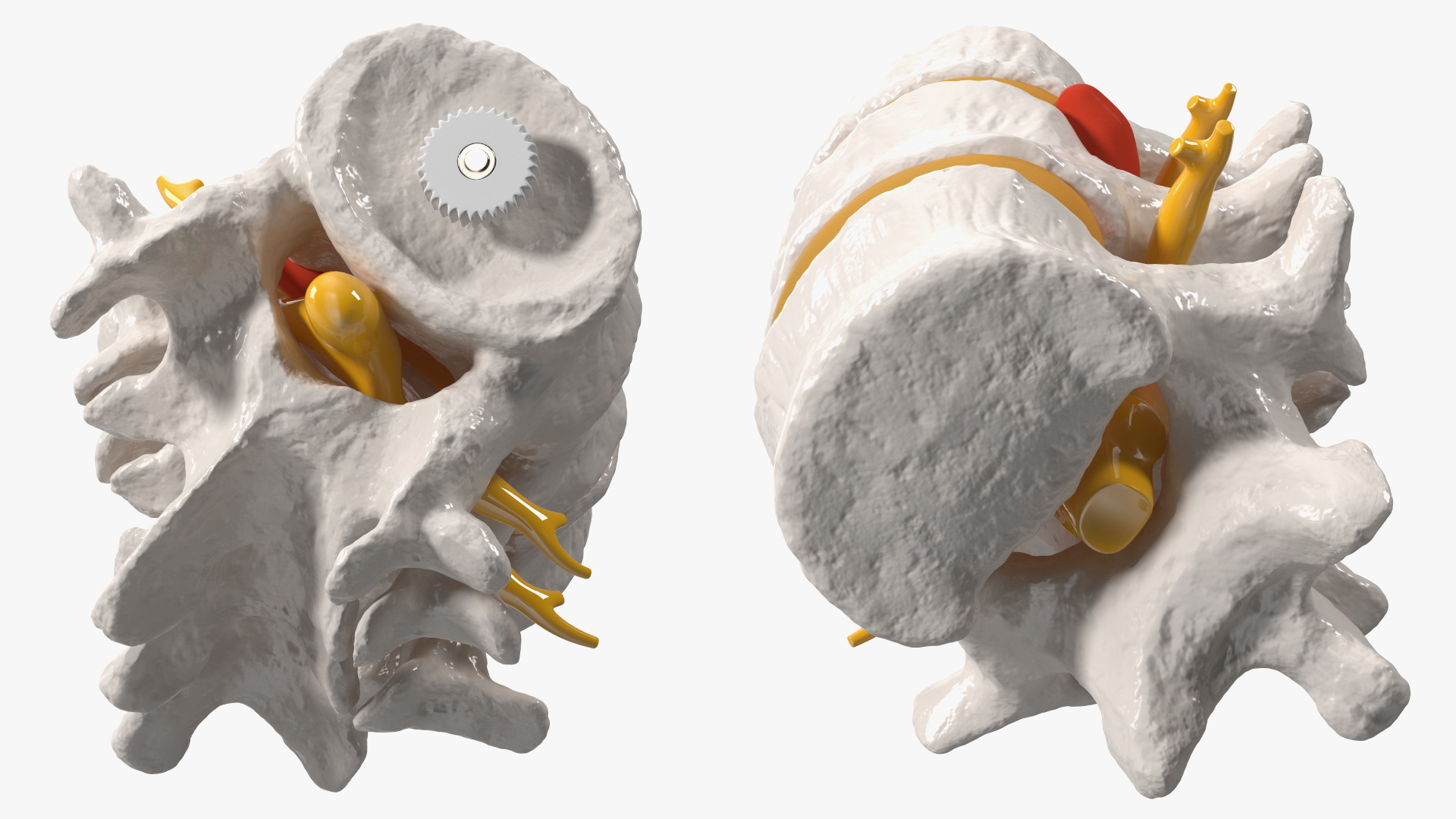 3D Spinal Vertebrae with Hernia model