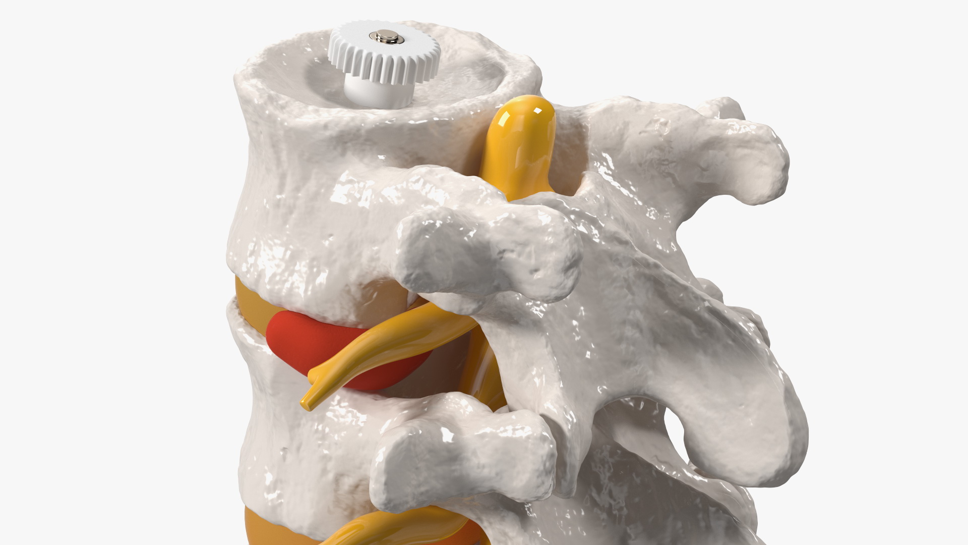 3D Spinal Vertebrae with Hernia model