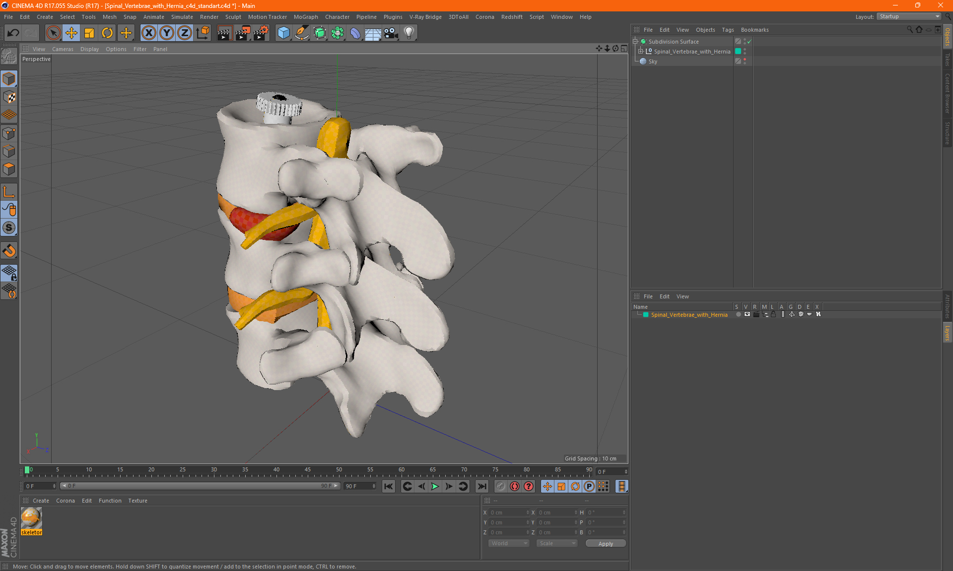 3D Spinal Vertebrae with Hernia model
