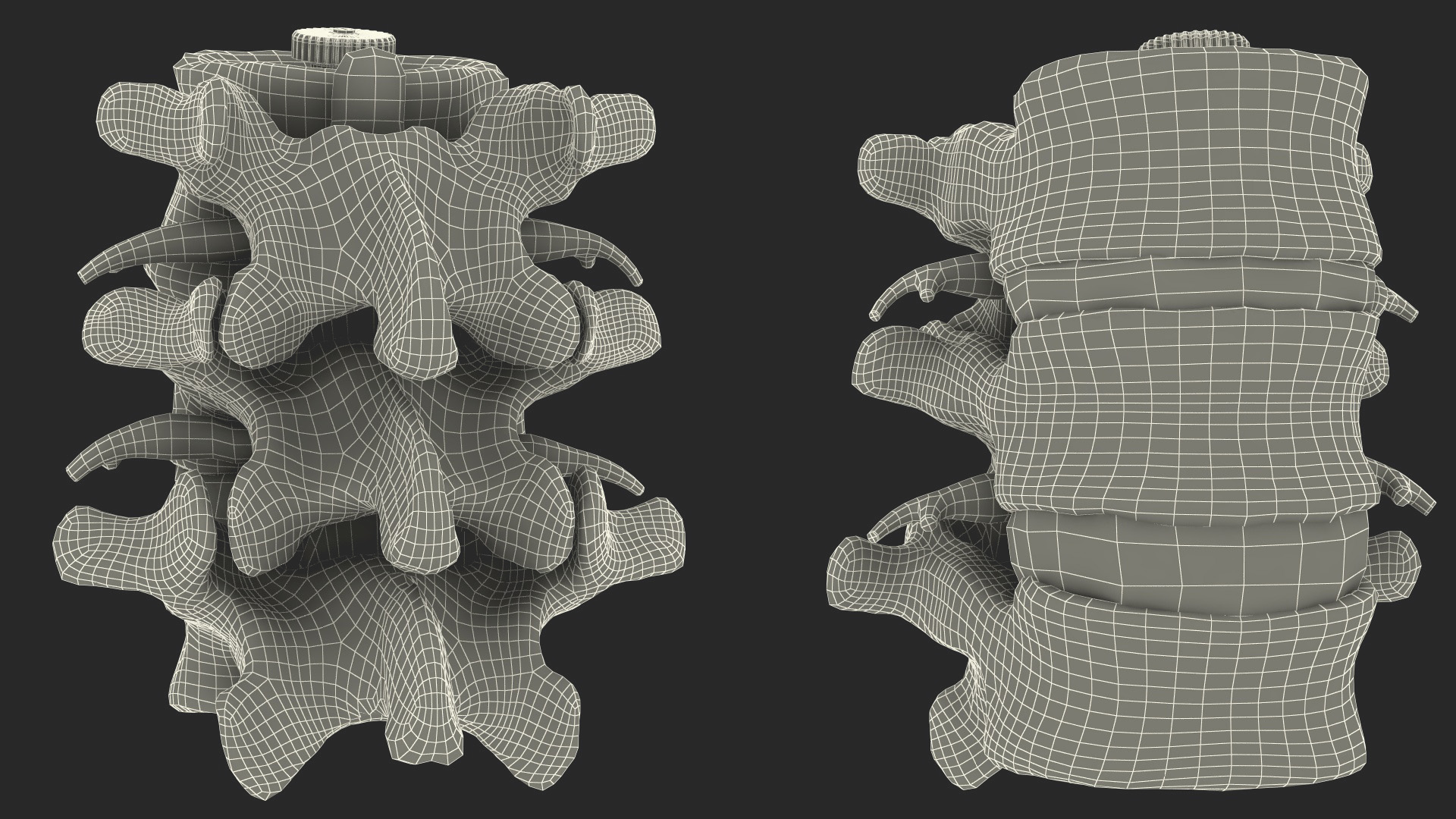 3D Spinal Vertebrae with Hernia model