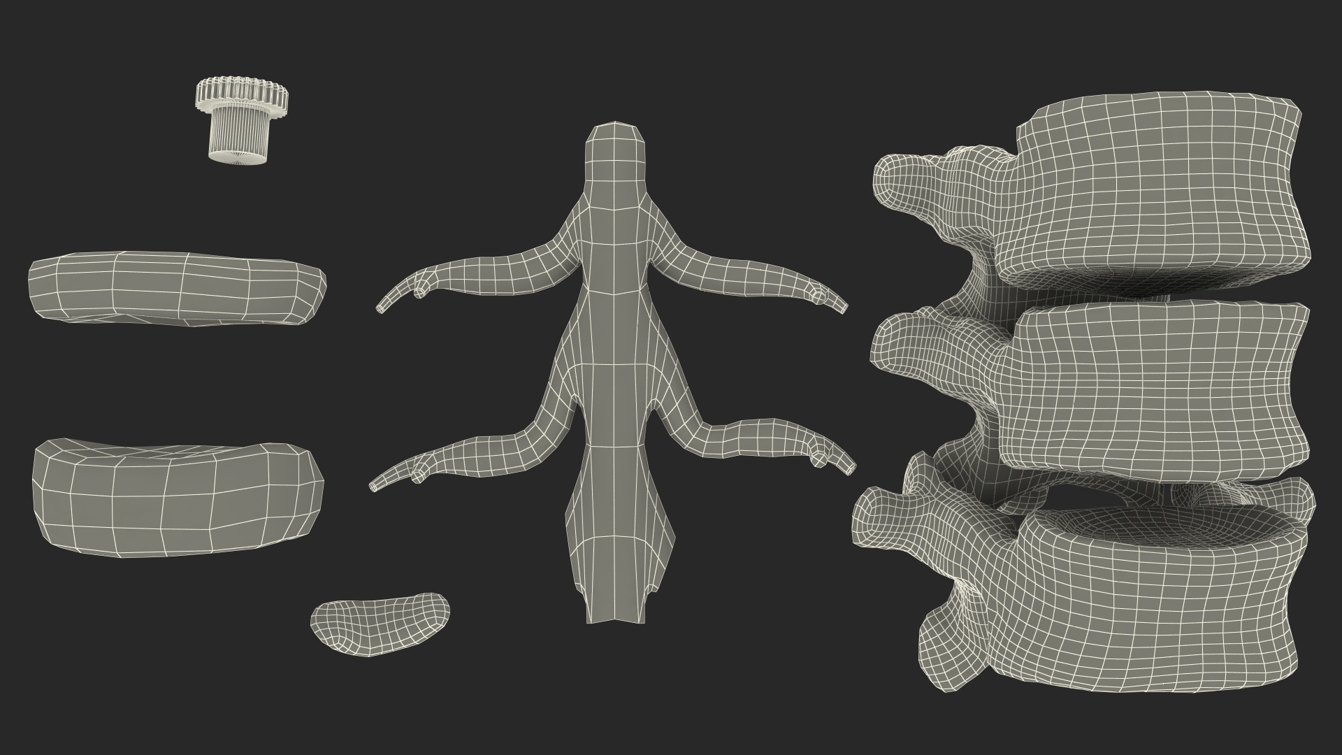 3D Spinal Vertebrae with Hernia model