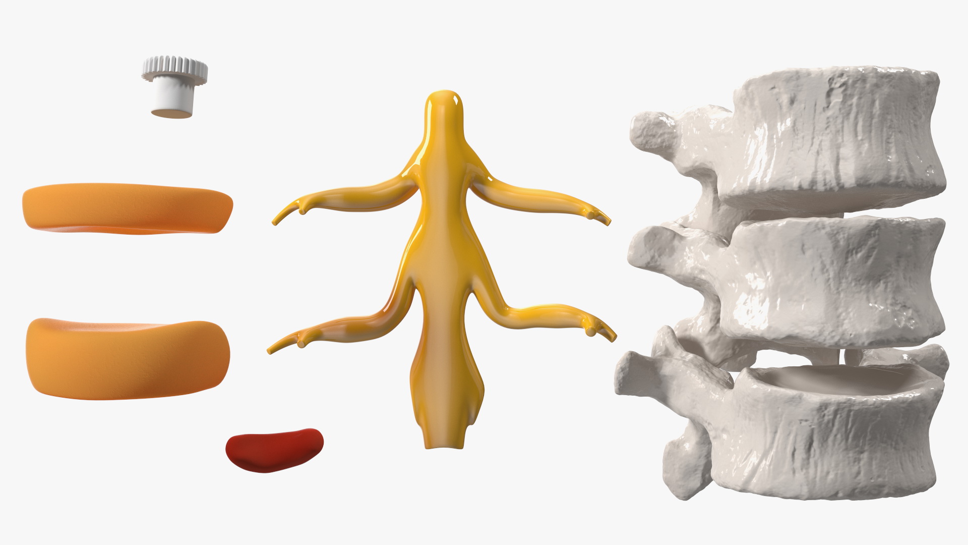 3D Spinal Vertebrae with Hernia model