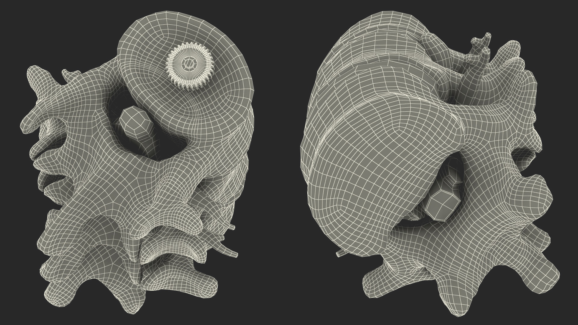 3D Spinal Vertebrae with Hernia model