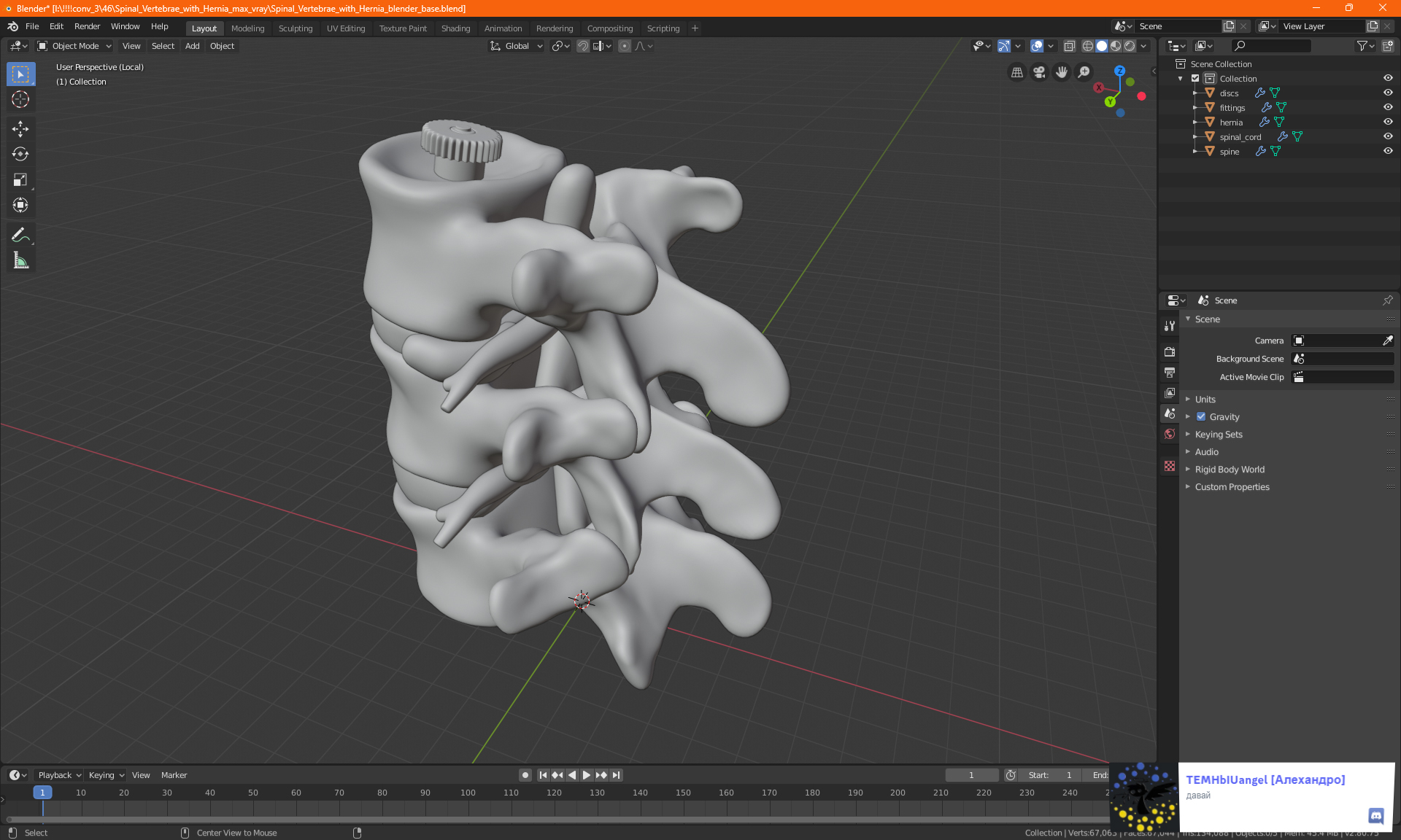 3D Spinal Vertebrae with Hernia model
