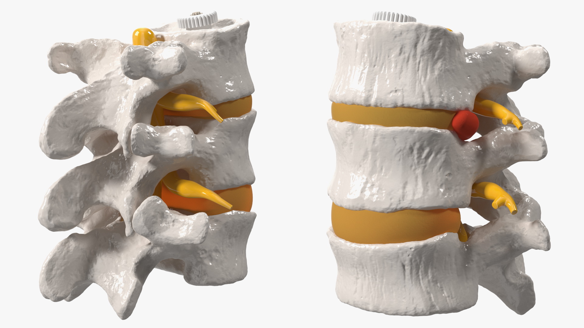 3D Spinal Vertebrae with Hernia model