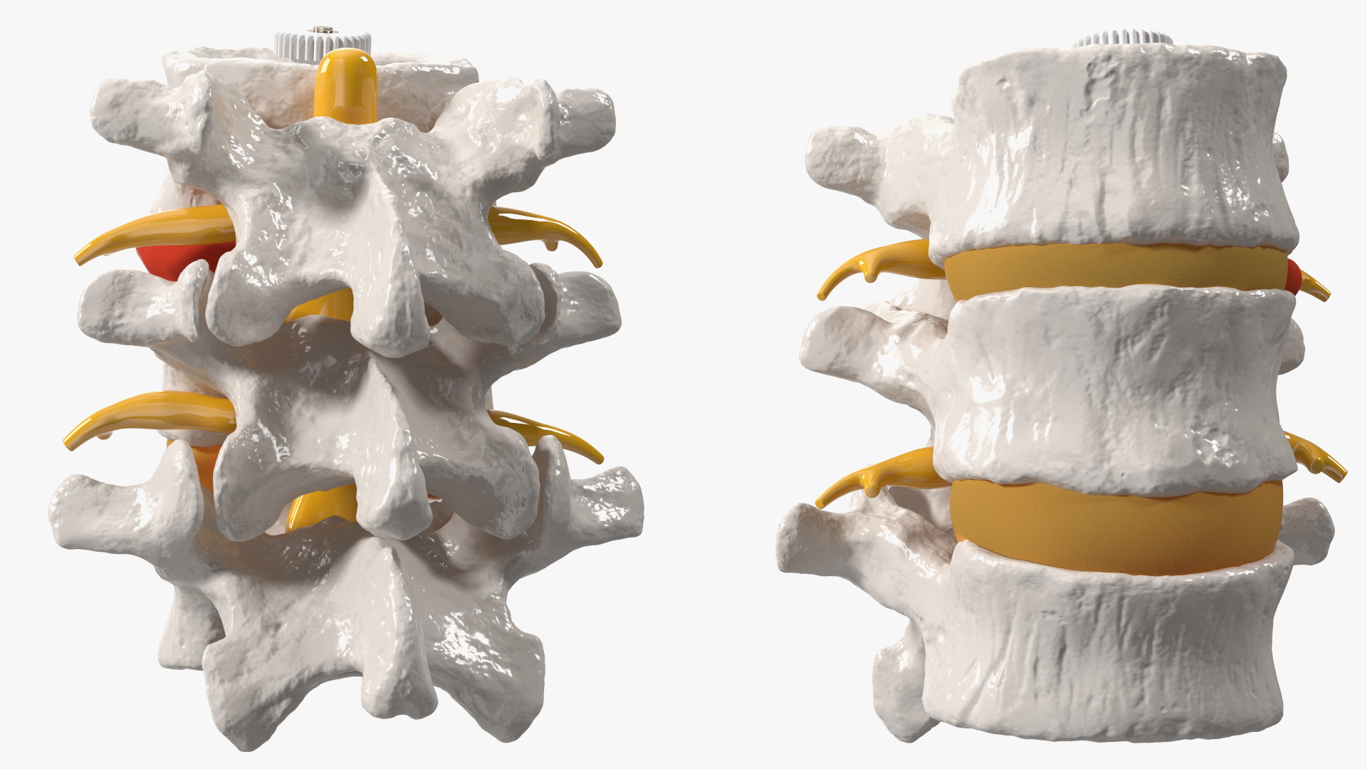 3D Spinal Vertebrae with Hernia model