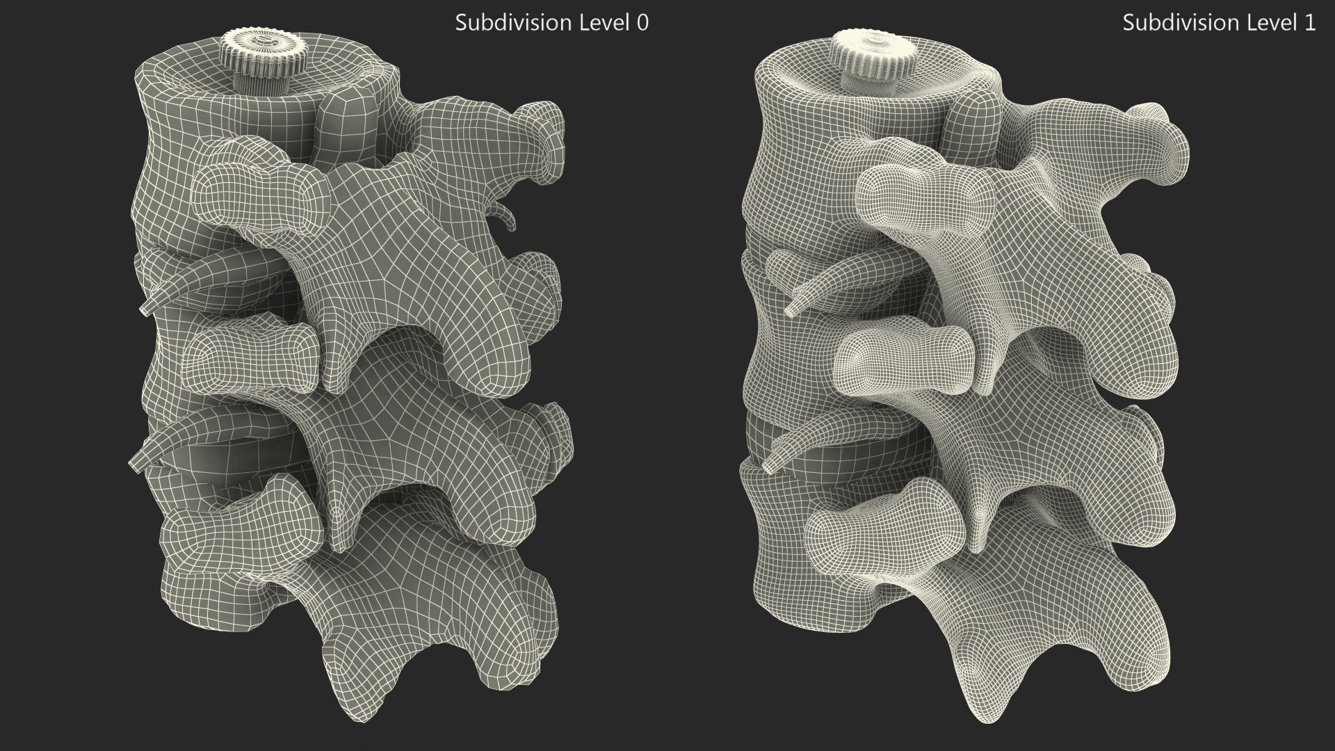 3D Spinal Vertebrae with Hernia model