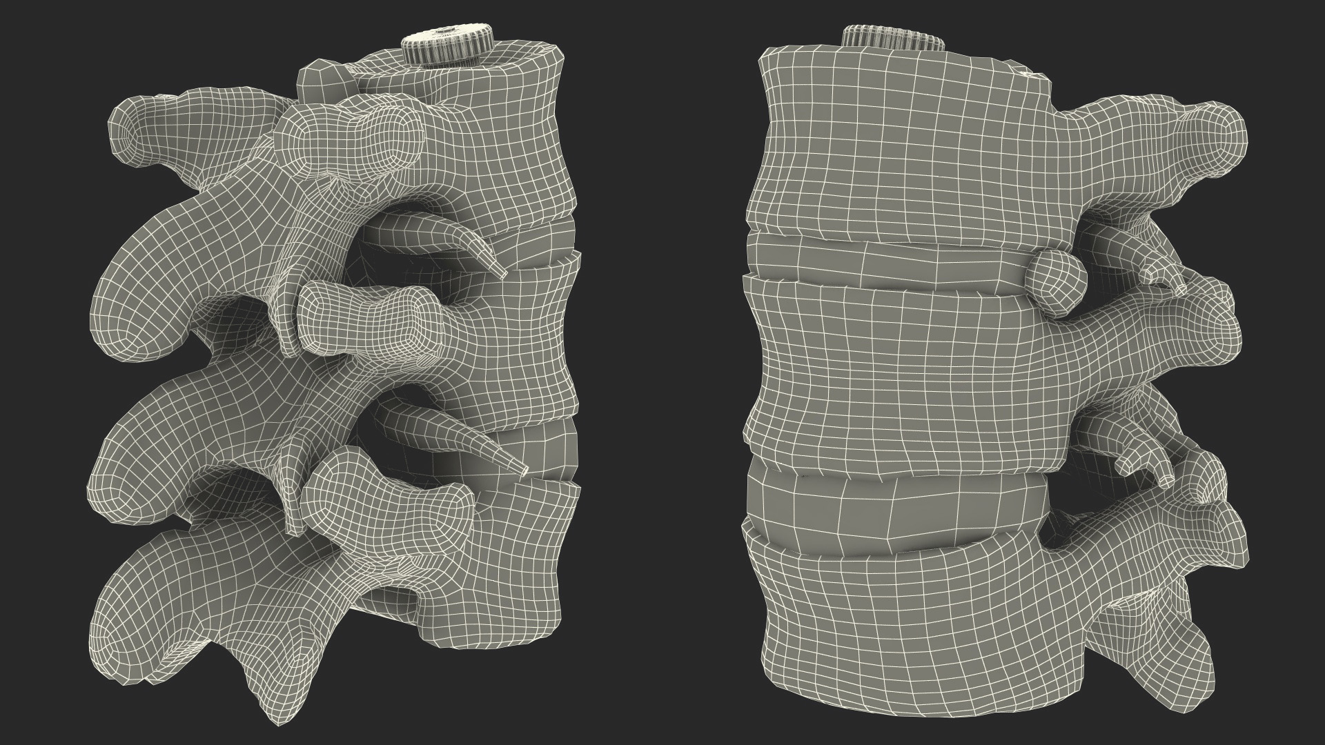 3D Spinal Vertebrae with Hernia model
