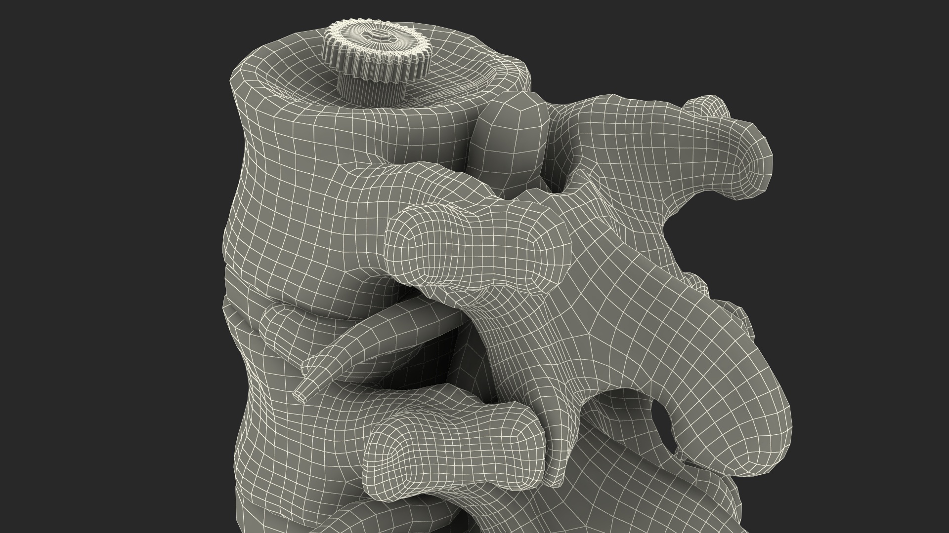 3D Spinal Vertebrae with Hernia model