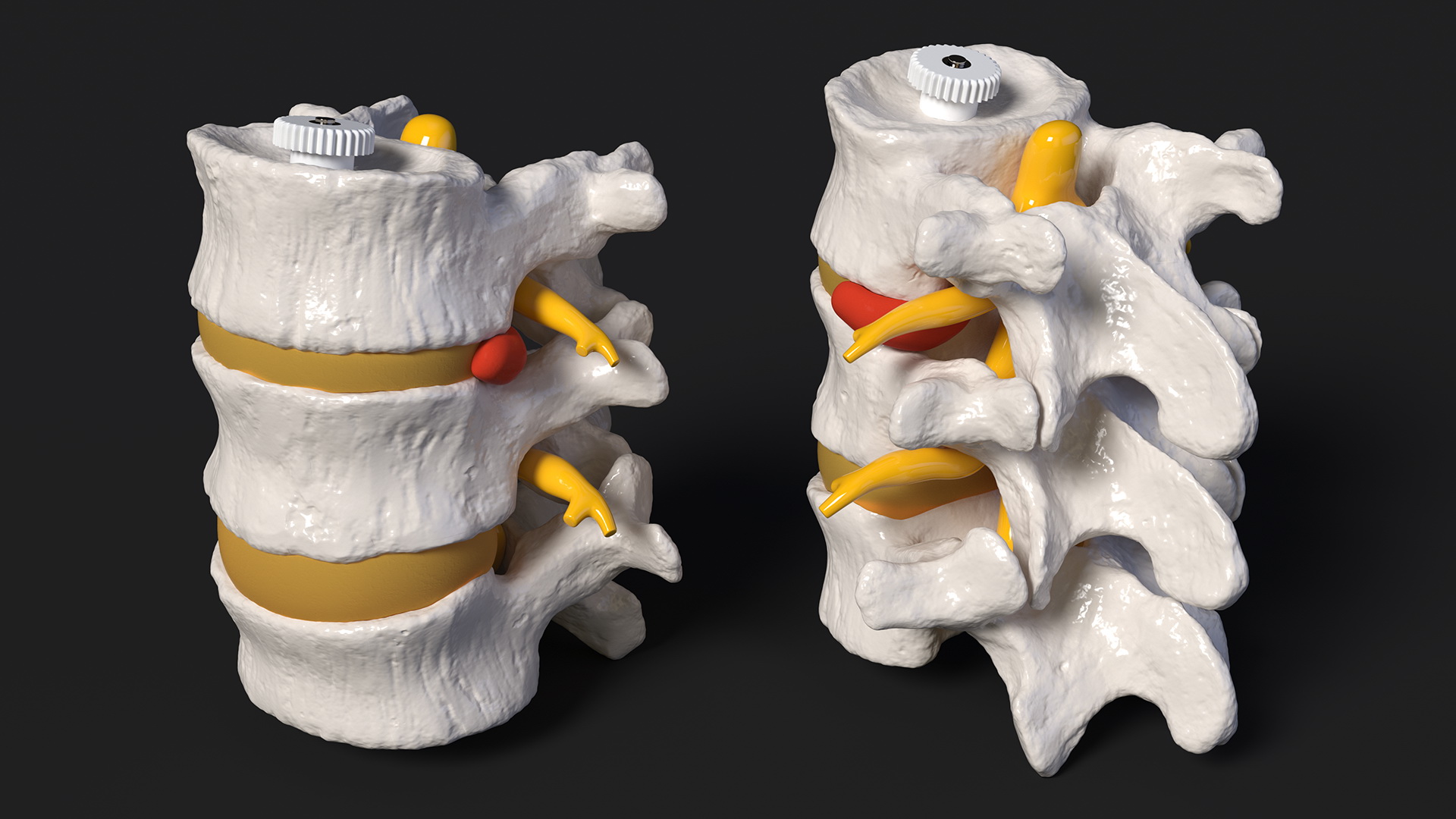3D Spinal Vertebrae with Hernia model