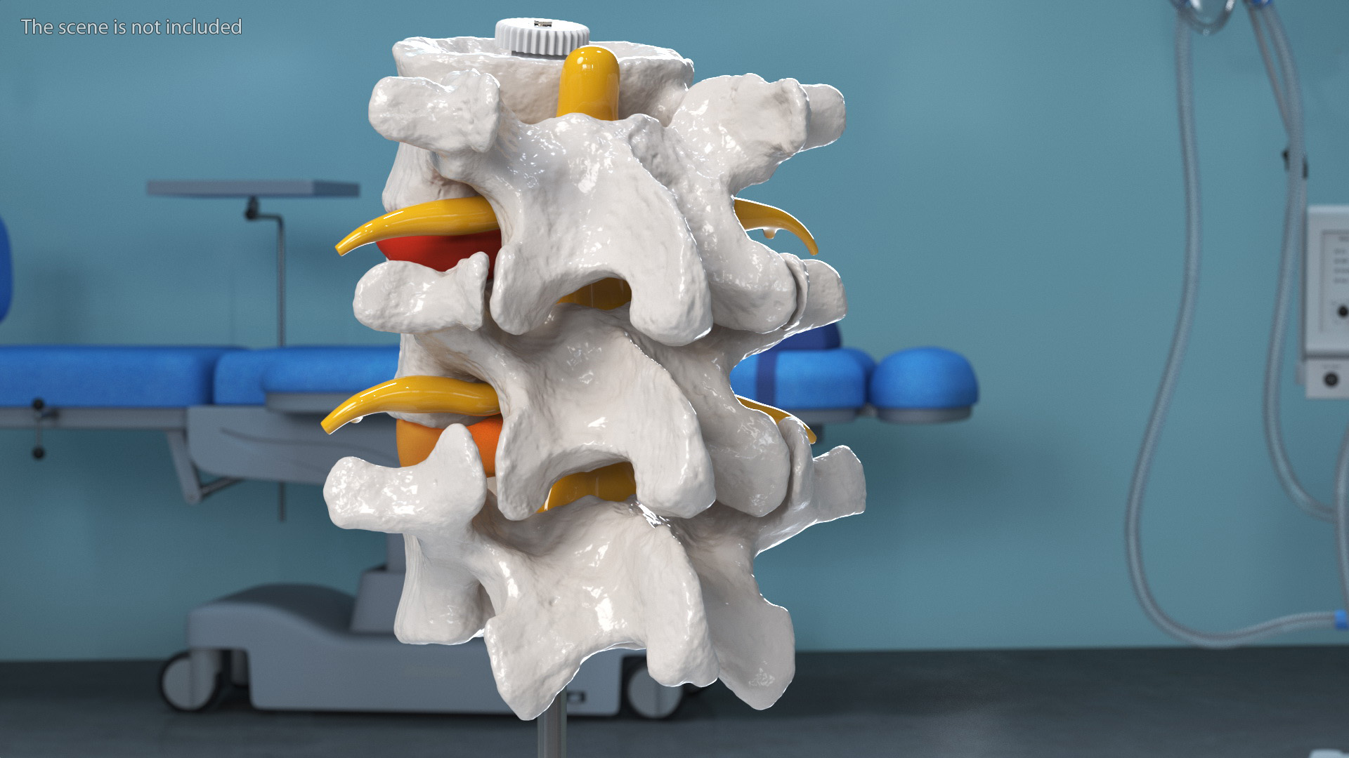 3D Spinal Vertebrae with Hernia model