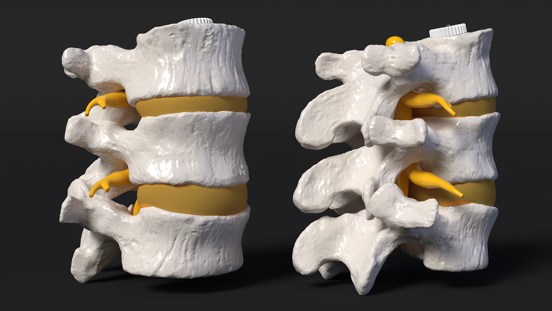 3D Spinal Vertebrae with Hernia model