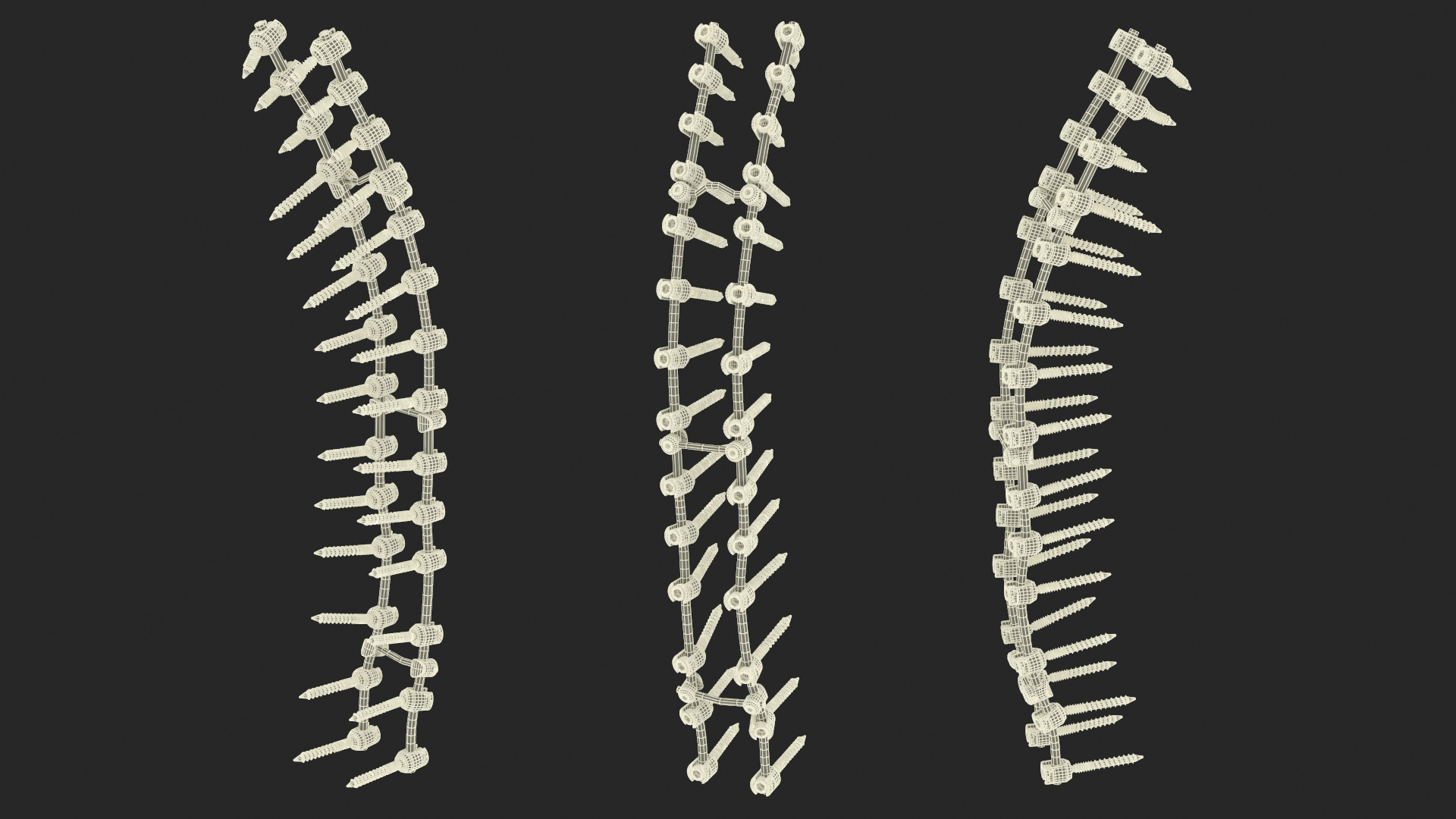 3D model Thoracic Spine Fixation System
