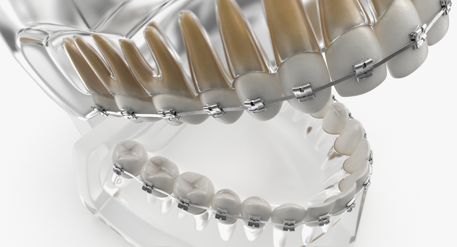 3D Transparent Dental Typodont Teeth Model With Braces