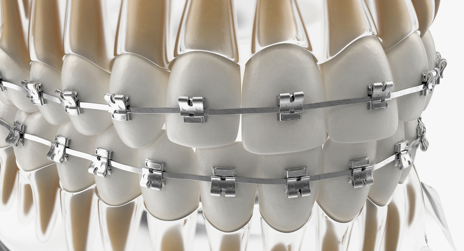 3D Transparent Dental Typodont Teeth Model With Braces