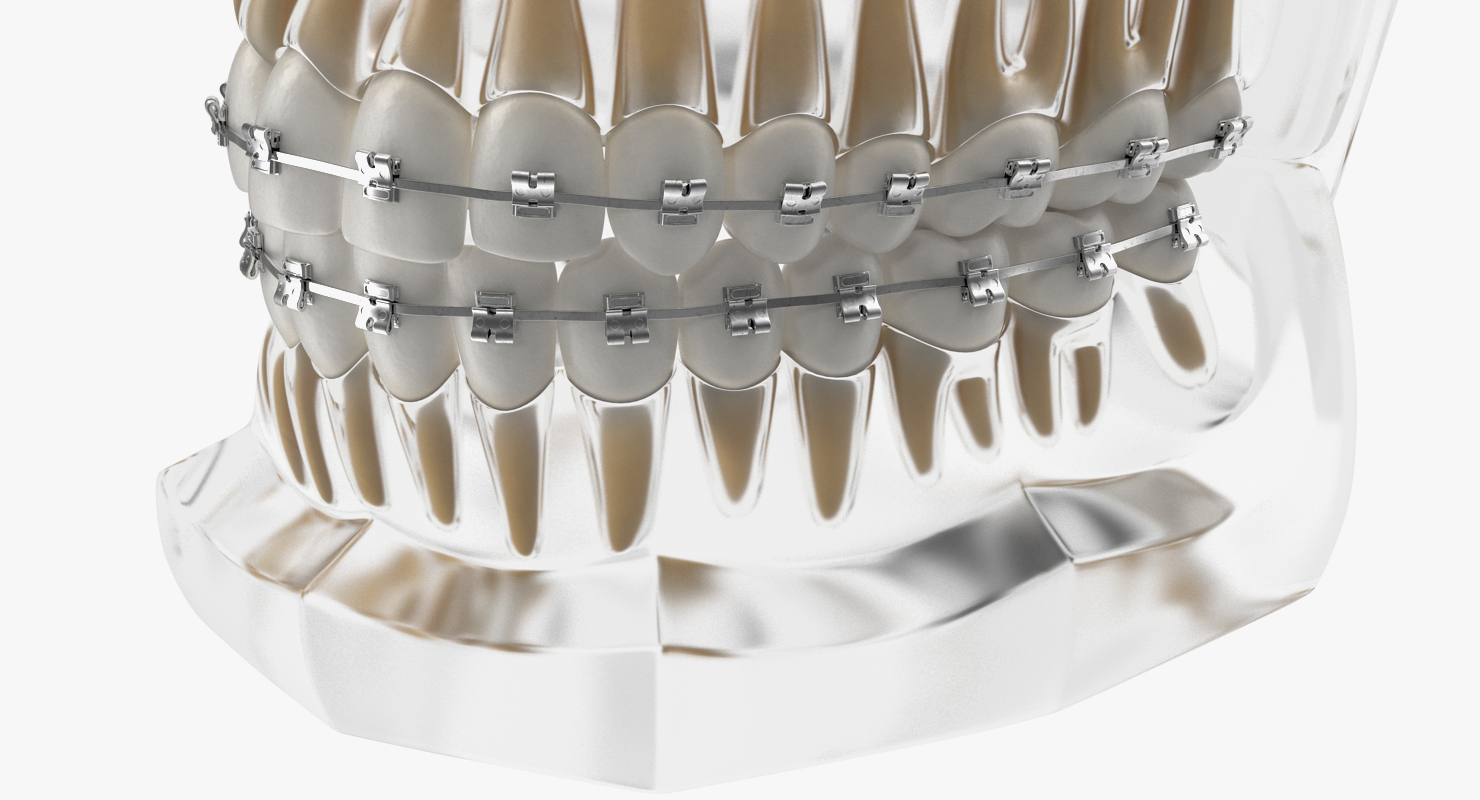3D Transparent Dental Typodont Teeth Model With Braces