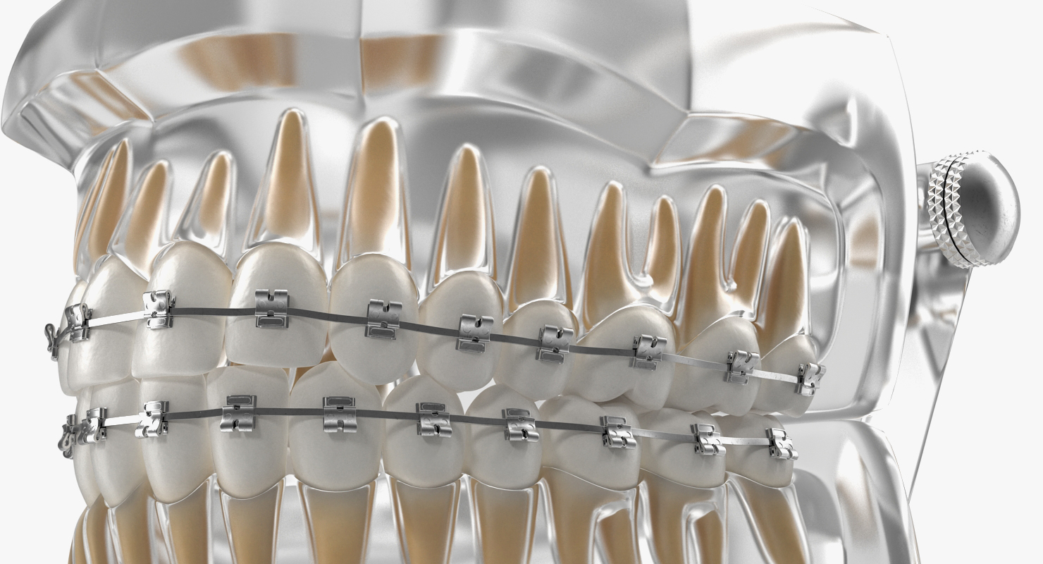 3D Transparent Dental Typodont Teeth Model With Braces