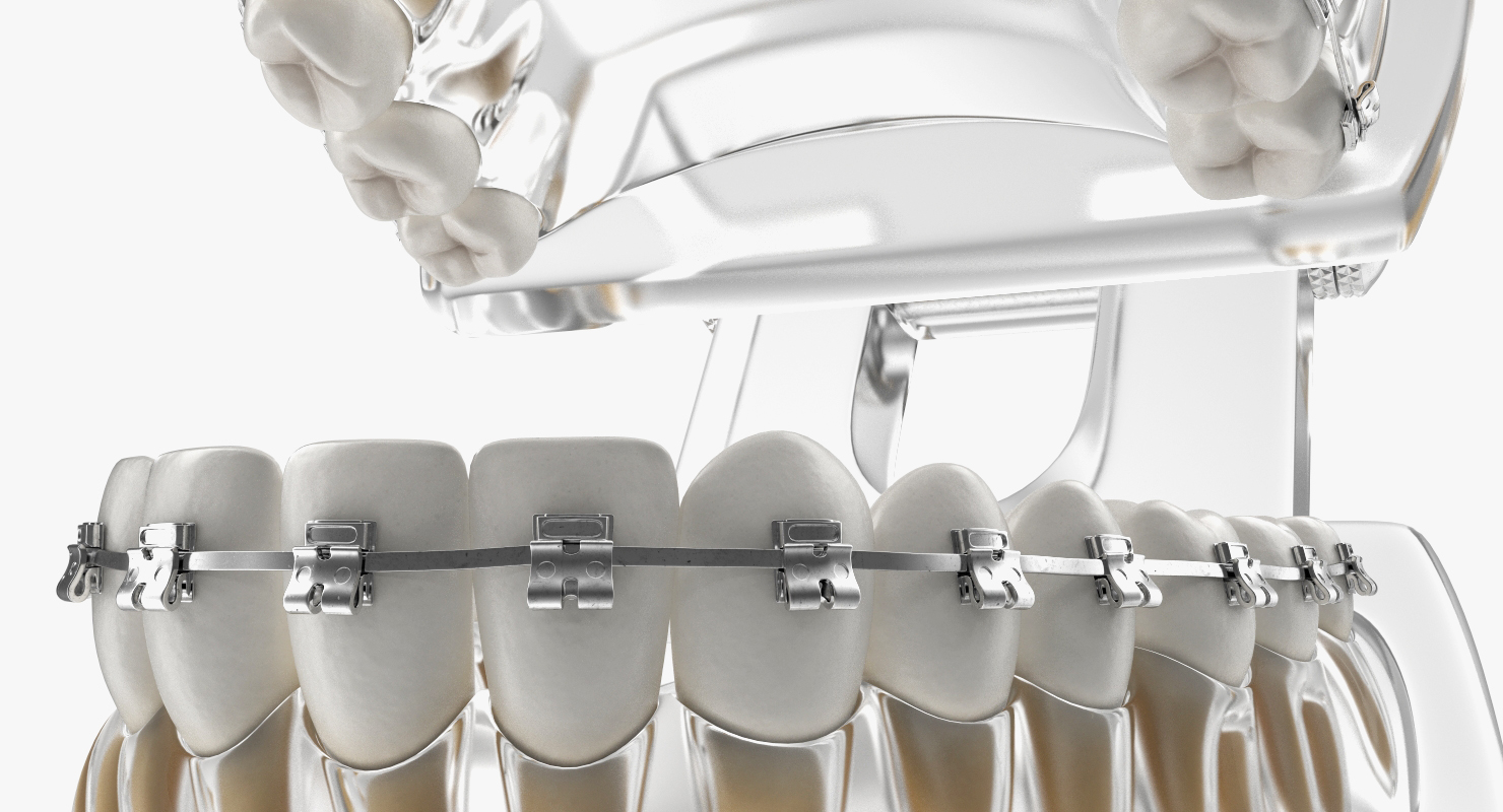 3D Transparent Dental Typodont Teeth Model With Braces