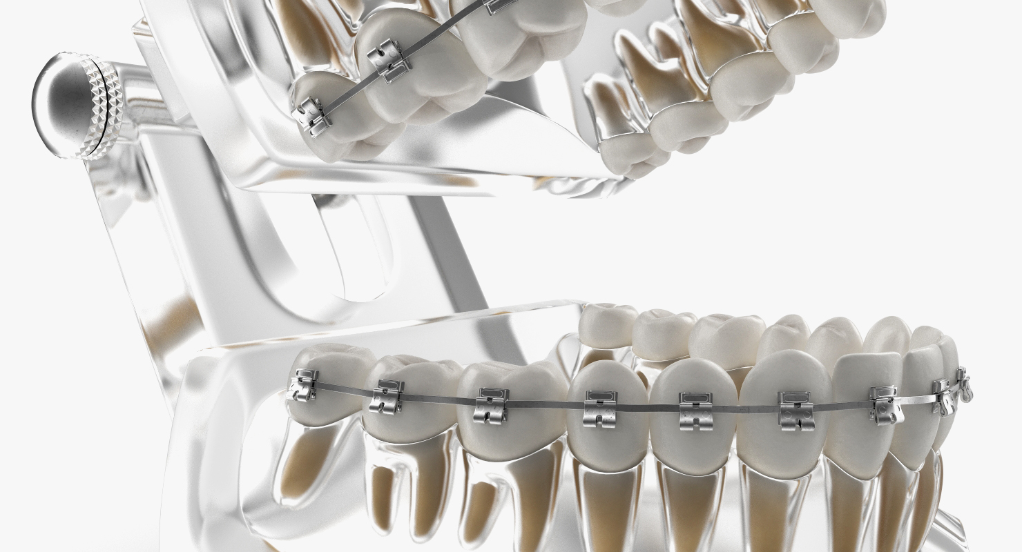 3D Transparent Dental Typodont Teeth Model With Braces