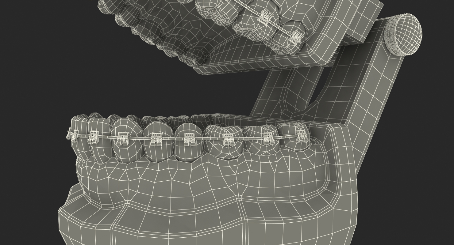 3D Transparent Dental Typodont Teeth Model With Braces