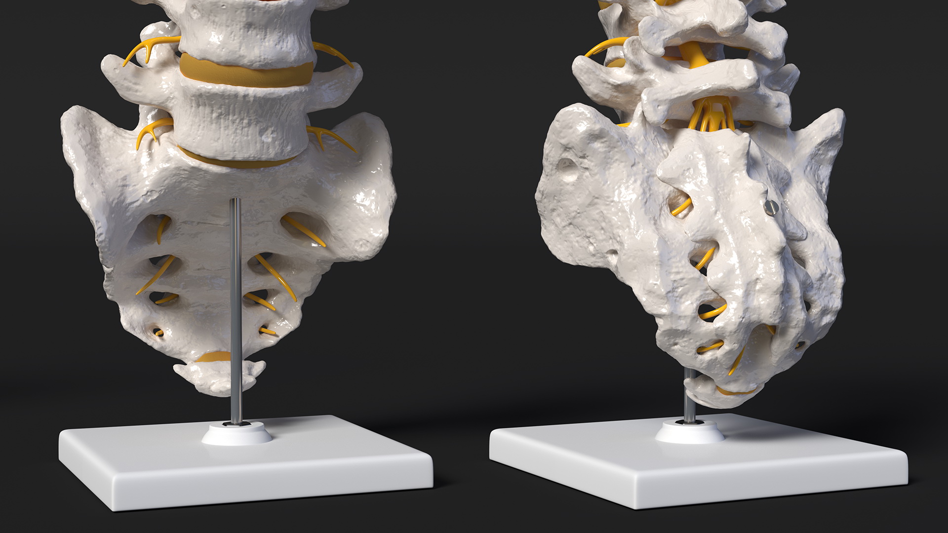 Spinal Column with Hernia on Stand 3D model