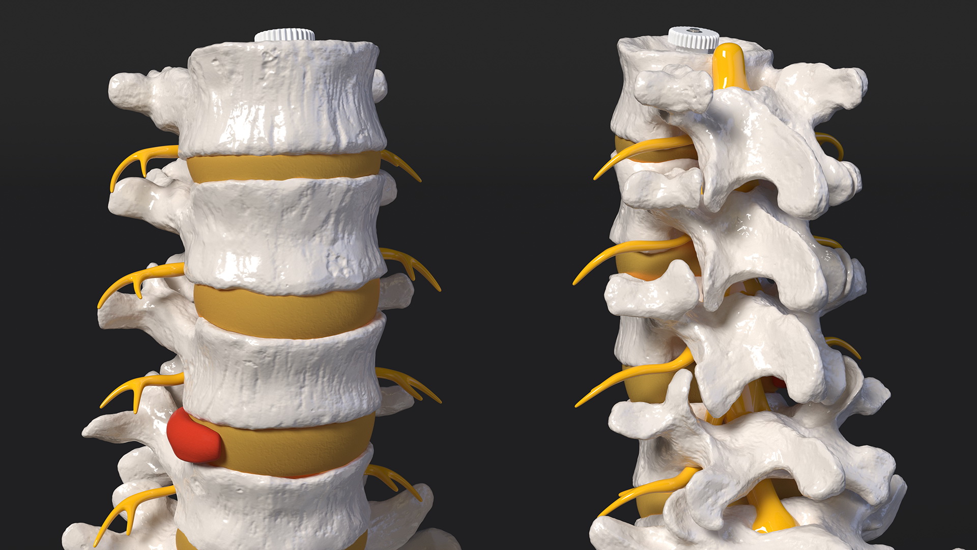 Spinal Column with Hernia on Stand 3D model
