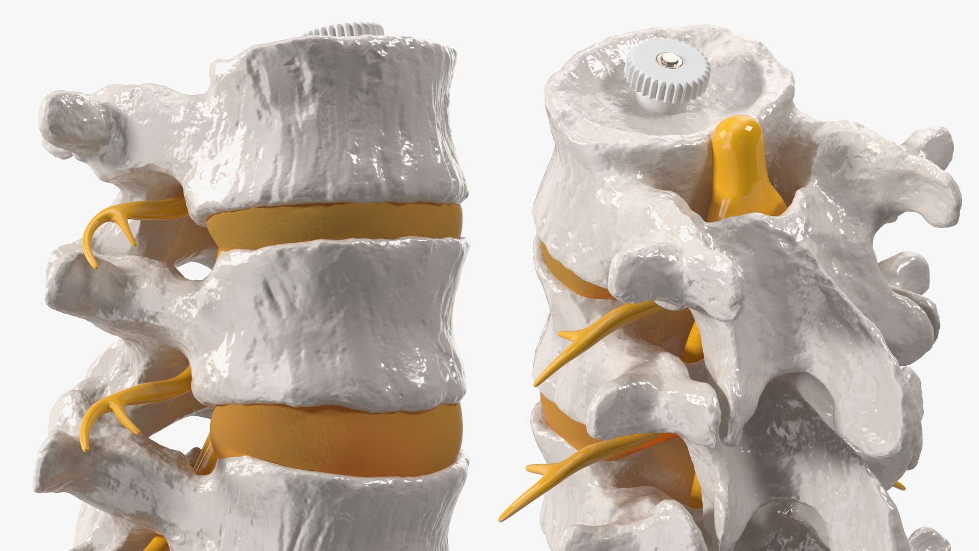 Spinal Column with Hernia on Stand 3D model