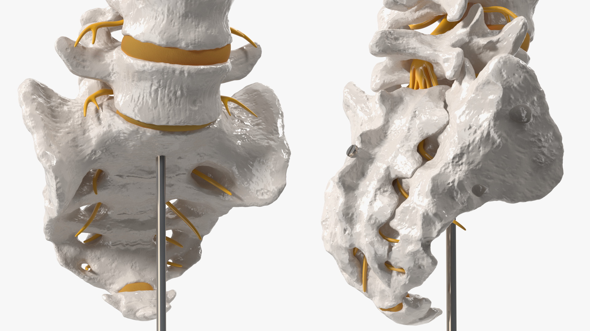 Spinal Column with Hernia on Stand 3D model
