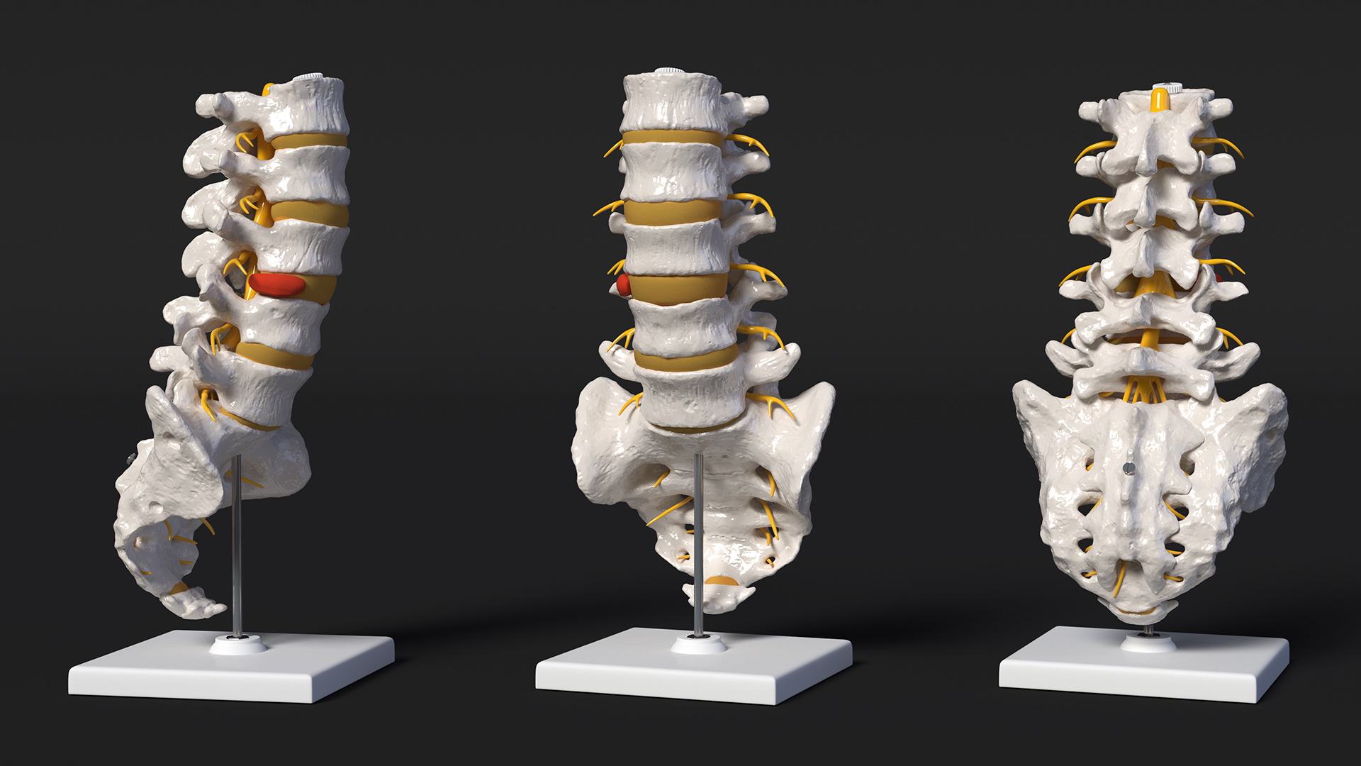 Spinal Column with Hernia on Stand 3D model