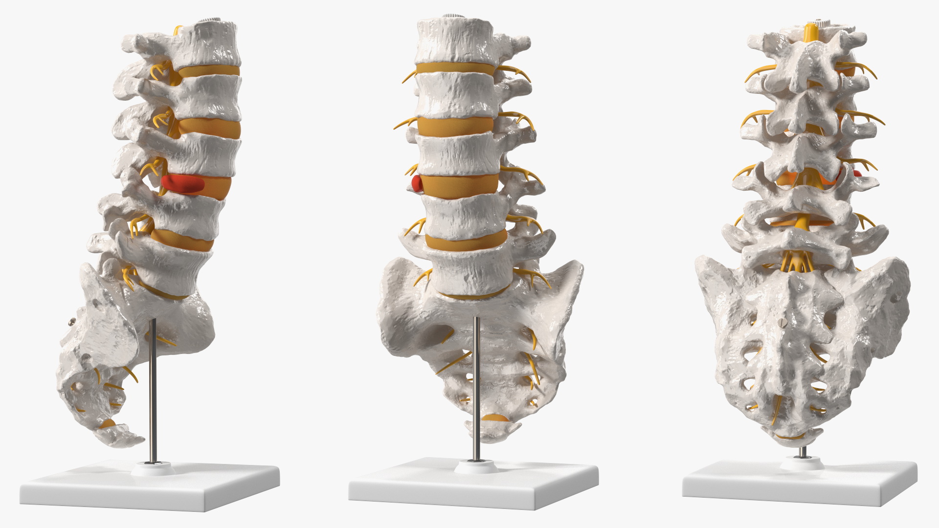 Spinal Column with Hernia on Stand 3D model