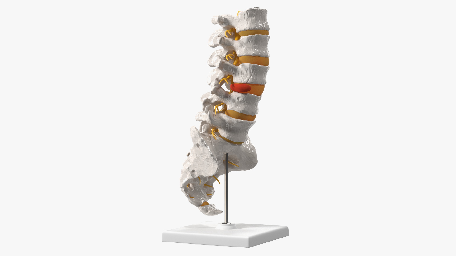 Spinal Column with Hernia on Stand 3D model