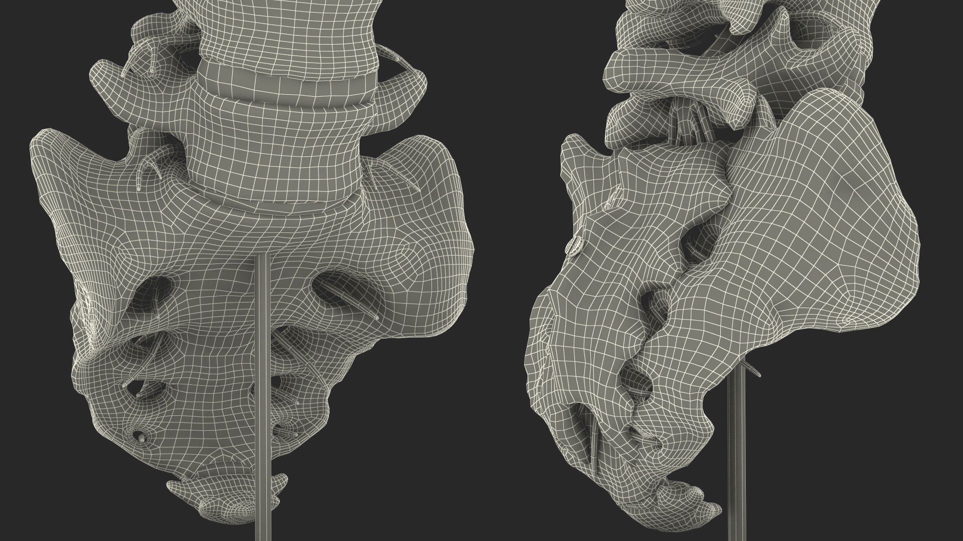 Spinal Column with Hernia on Stand 3D model